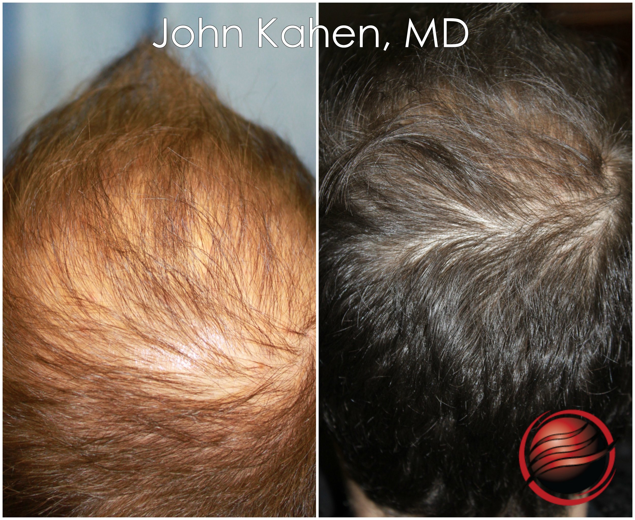 PRP Seattle | Hair Restoration Using Non Surgical Methods