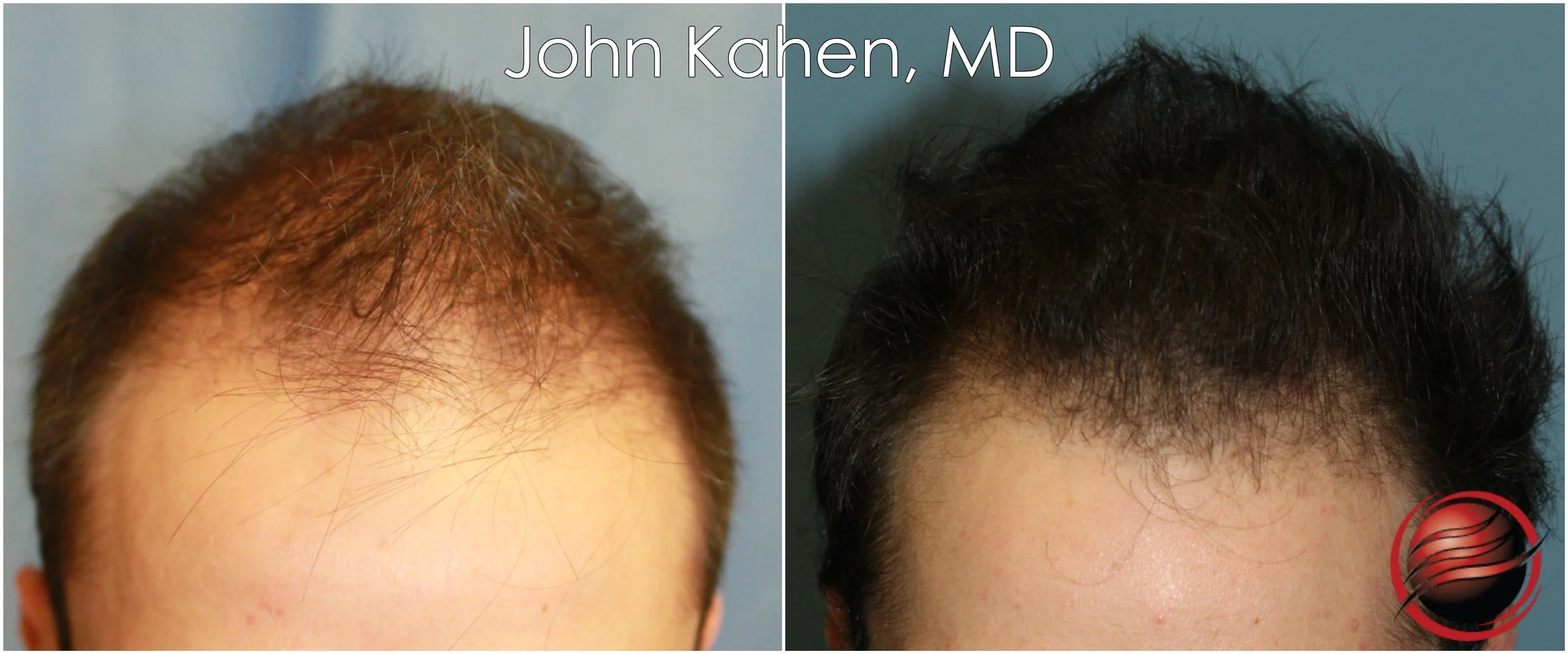 John Kahen MD PRP 3.jpg