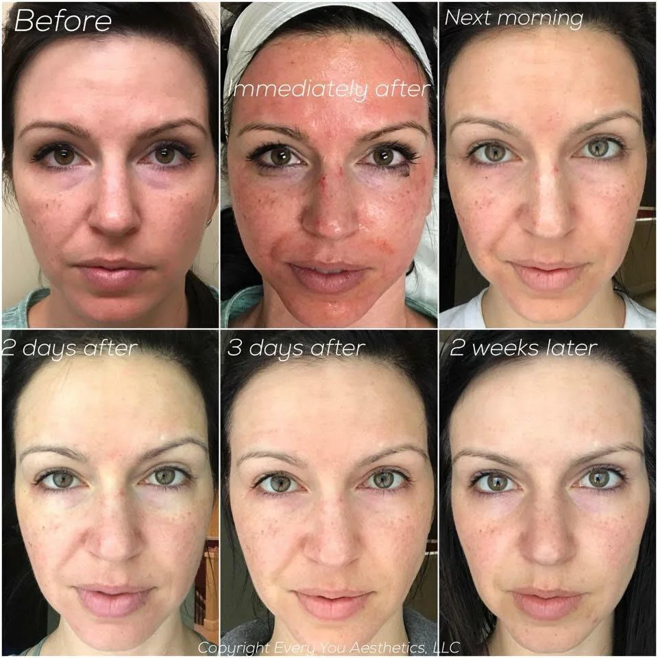 Vampire Facial Platelet Rich Plasma Facial Dr Kass what-is-after-life-q-a-youtube