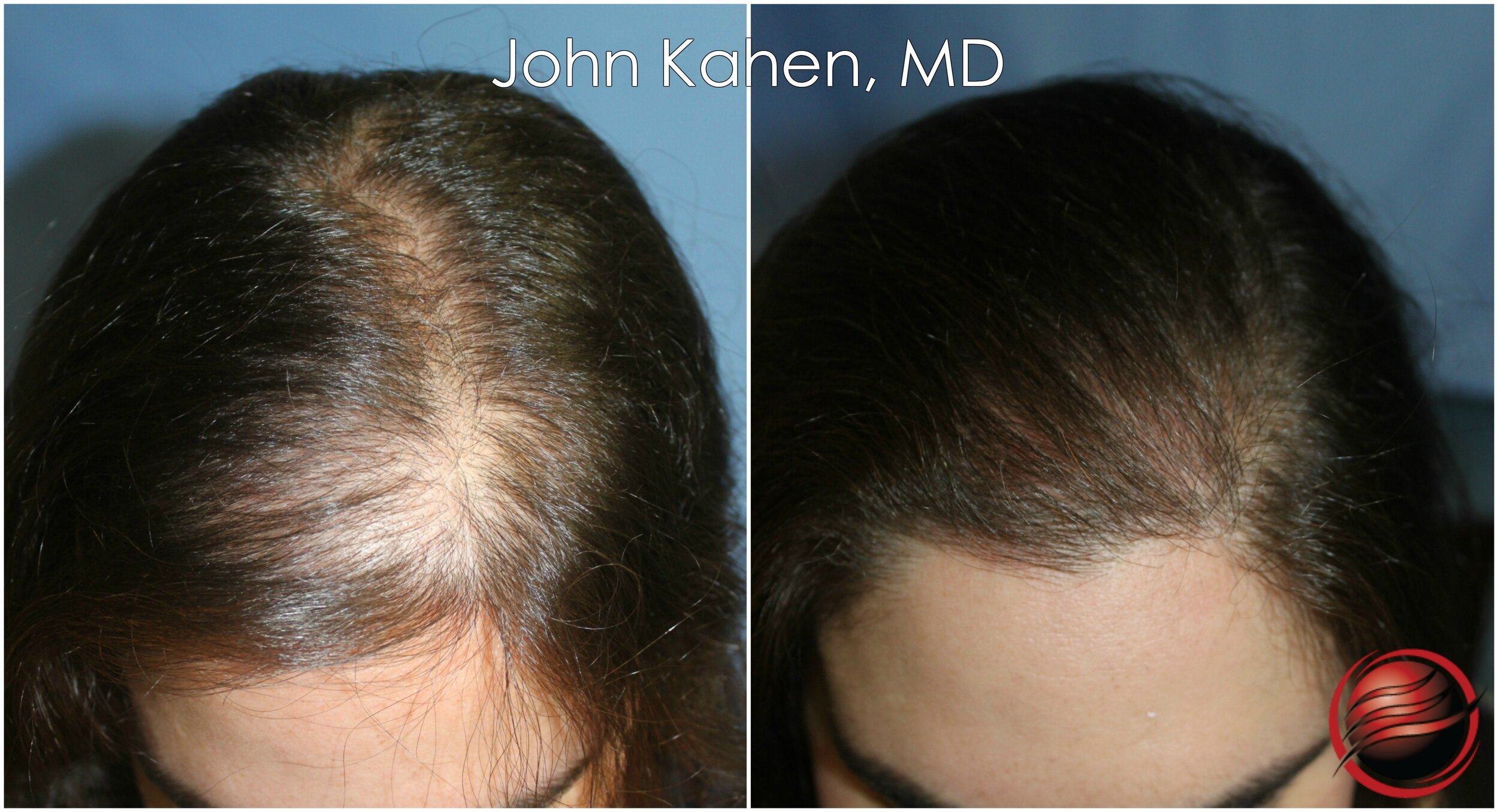 PRP Seattle | Hair Restoration Using Non Surgical Methods
