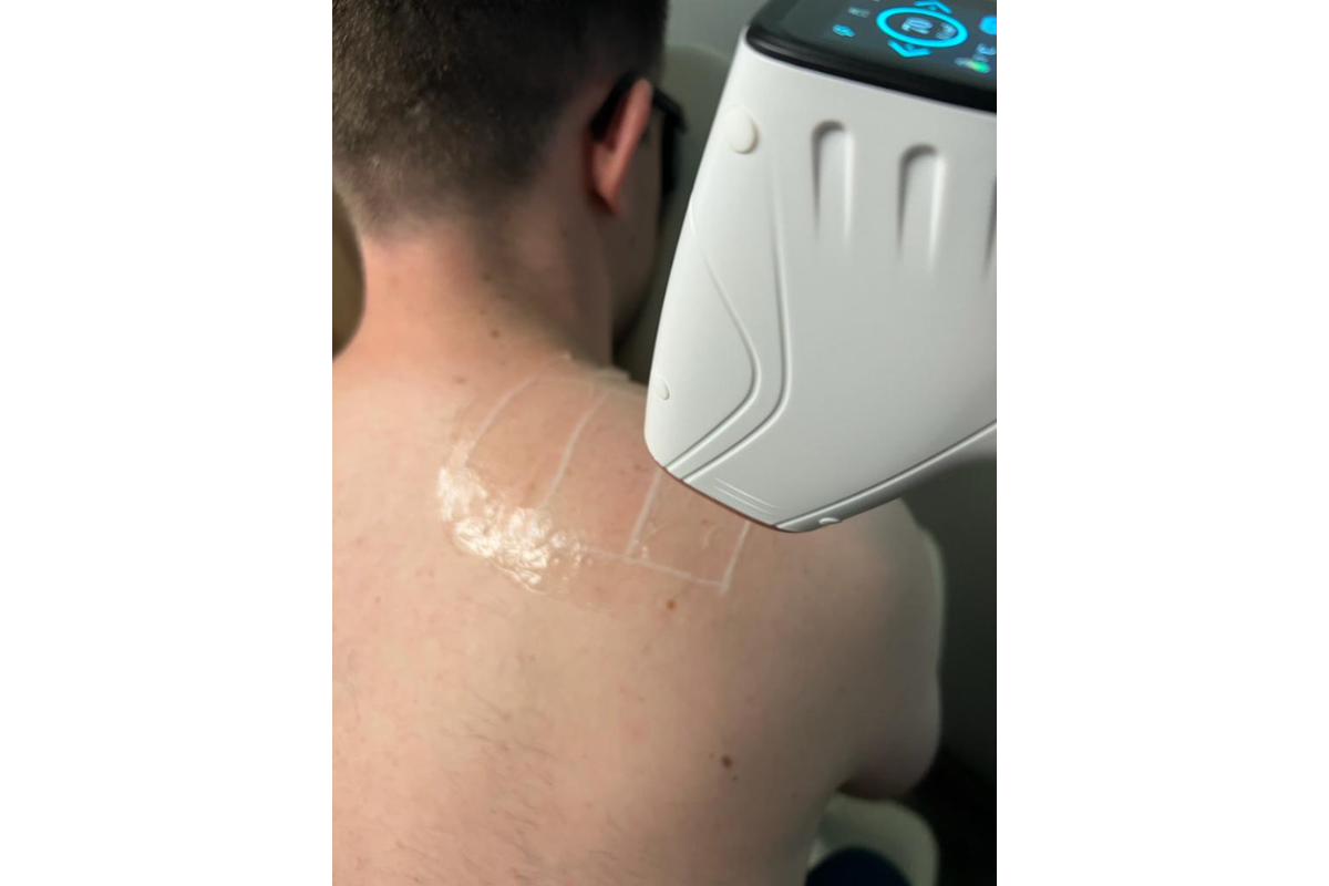 Permanent Hair Removal for Men