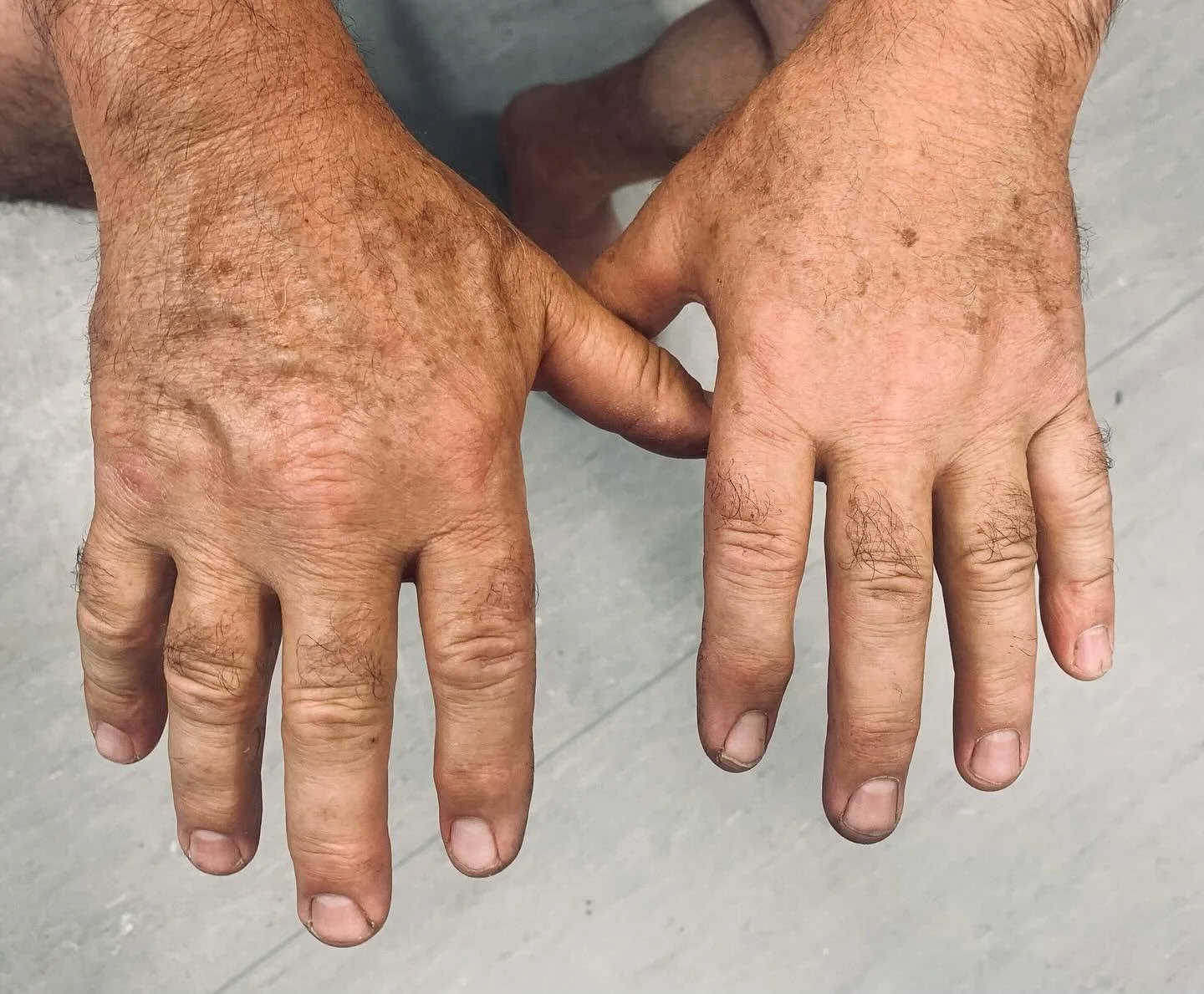 Photo showing the difference in sun damage of a truck driver’s hands!