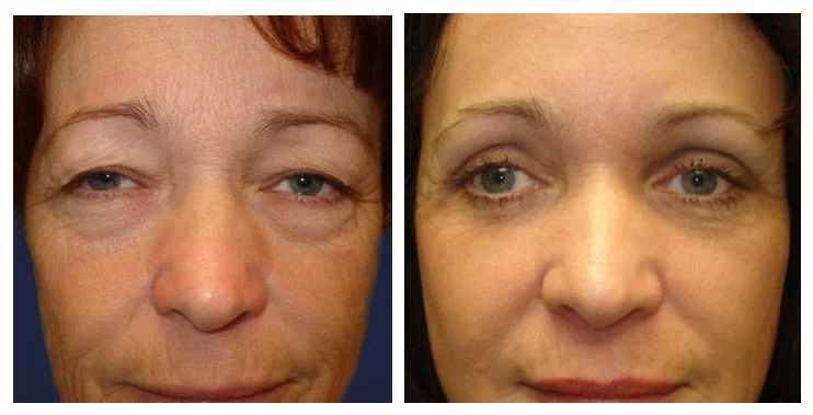 Above: Laser facial skin rejuvenation with upper and lower eyelid blepharoplasty