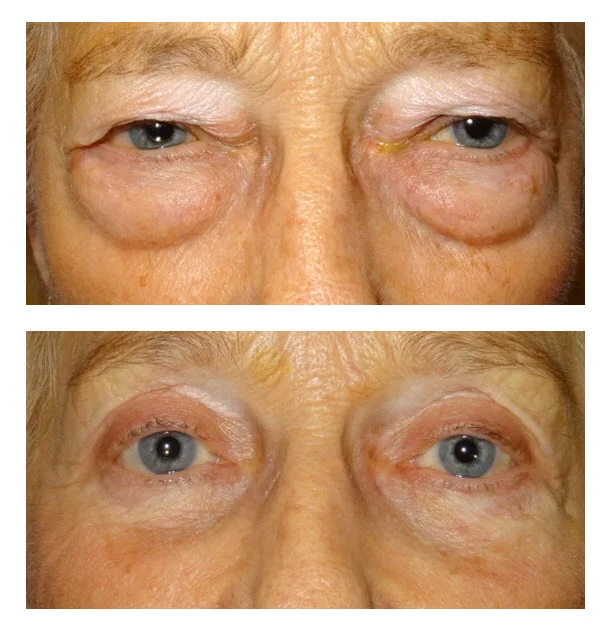 Upper and lower eyelid blepharoplasty