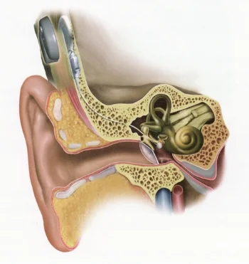 L'implant d'oreille moyenne Vibrant Soundbridge de Med-El