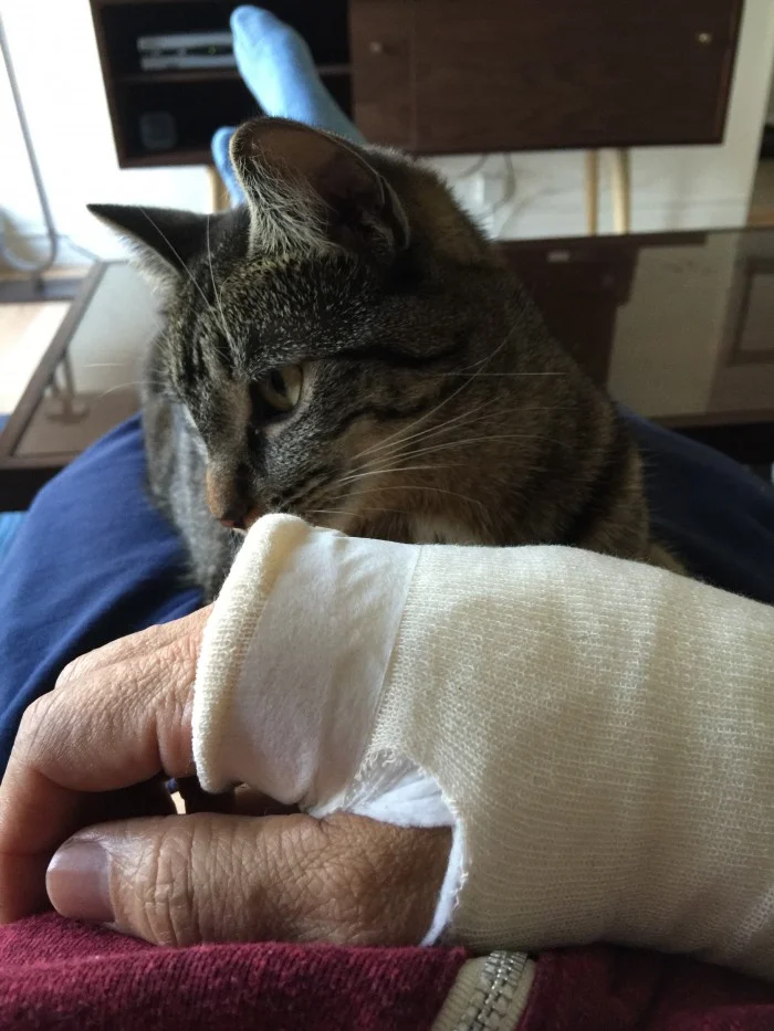 Post Surgery Update: I Feel Improvement Already!