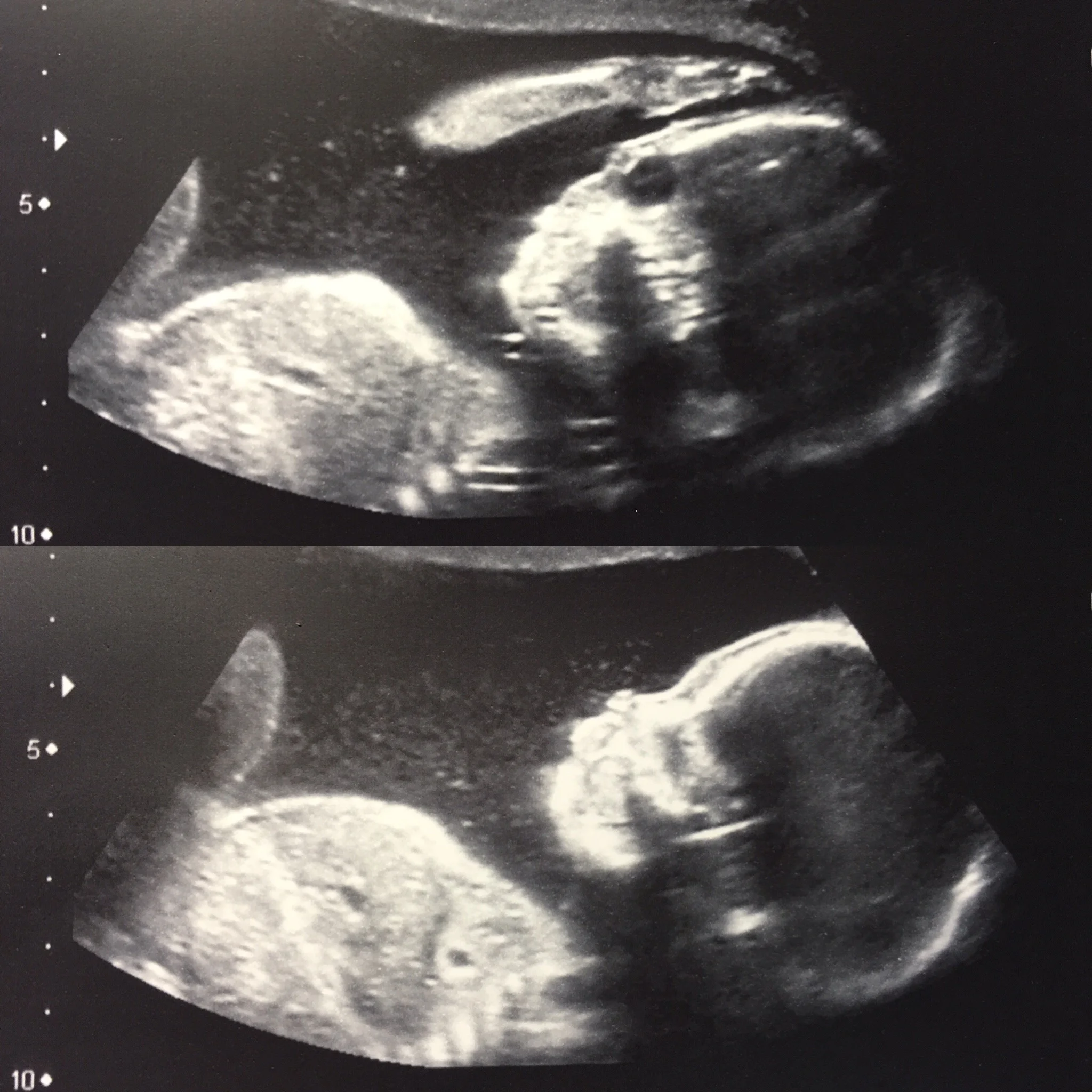 Baby girl doing the thinker pose and looking cute in her 20 week scan!