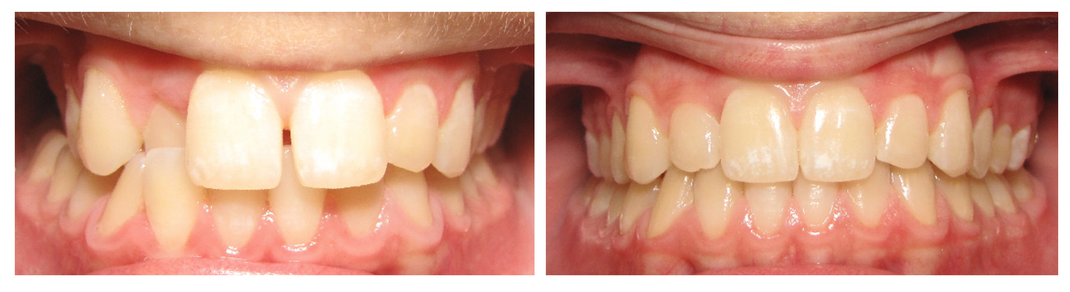 Teen boy anterior before & after Invisalign