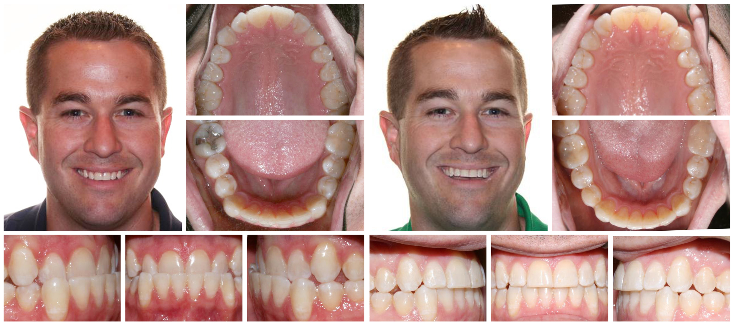 Adult male composite before & after Invisalign