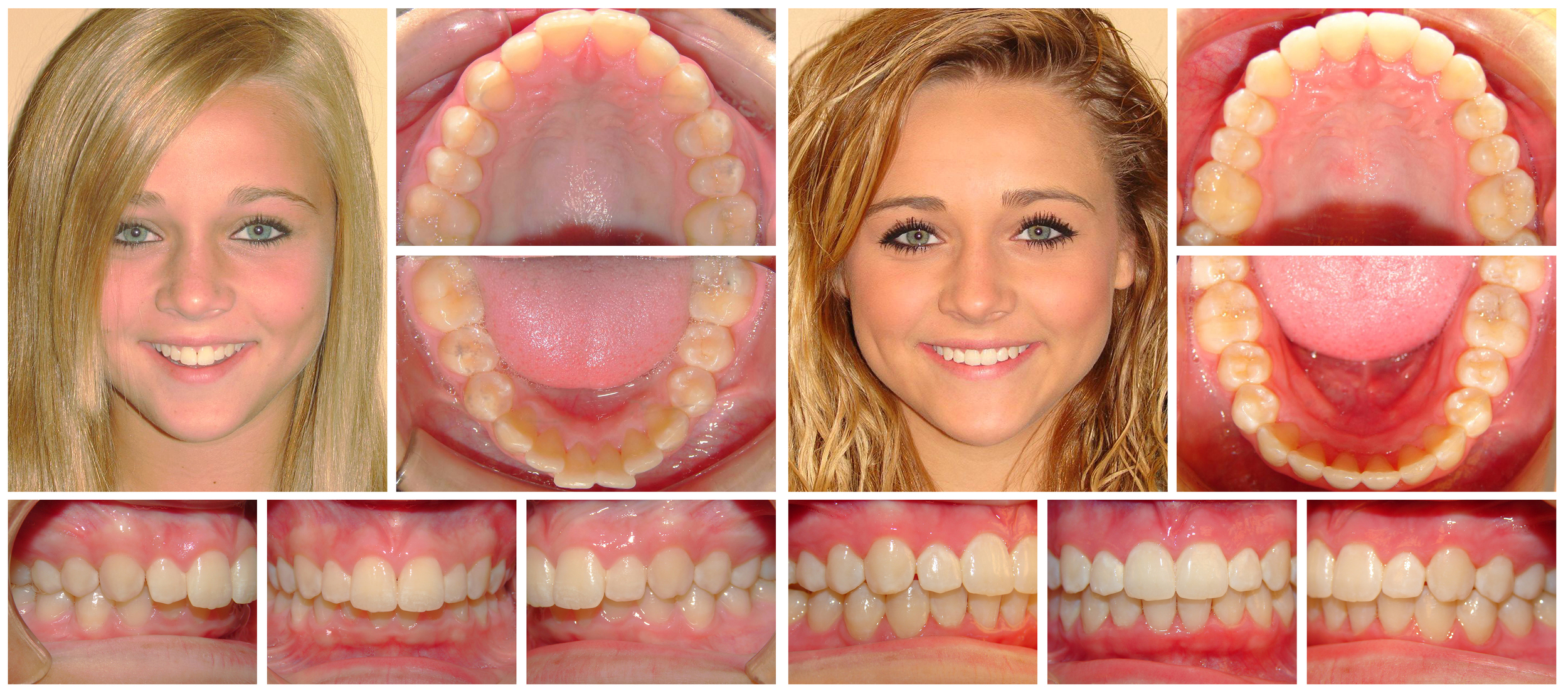 Teen girl 2 composite before & after Invisalign