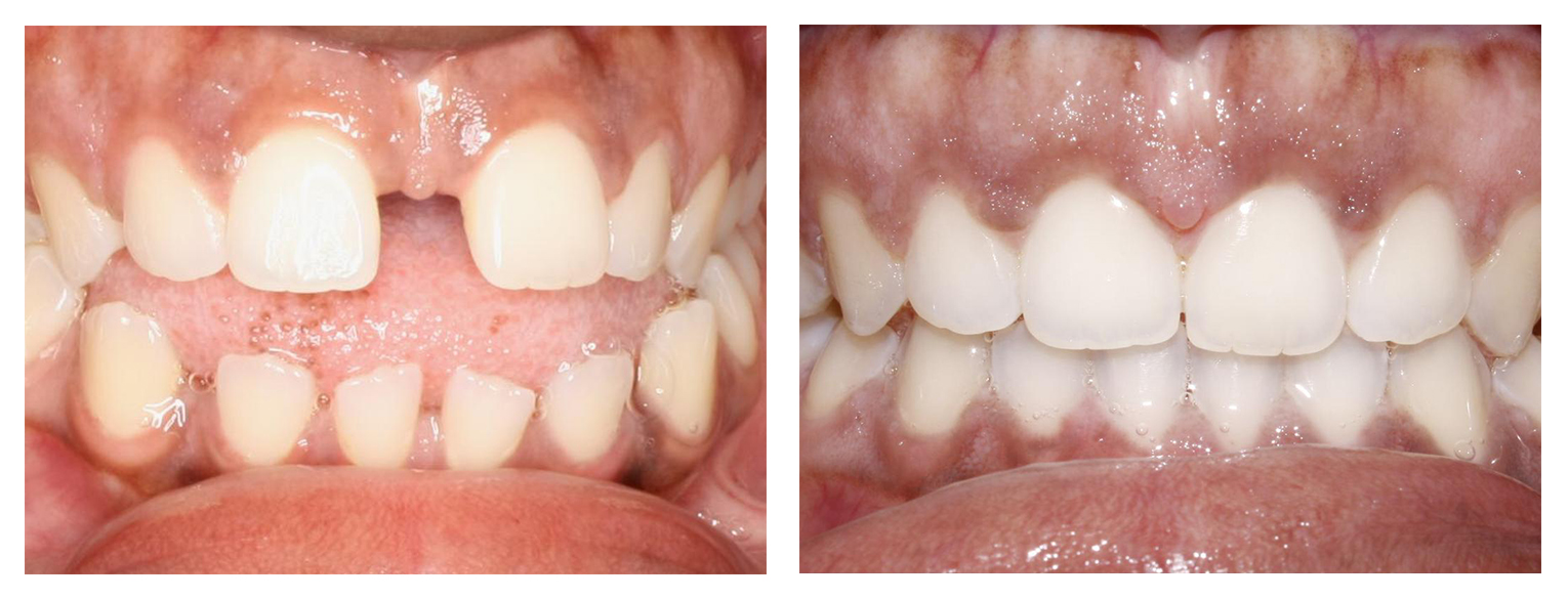 Woman 2 anterior before & after Invisalign