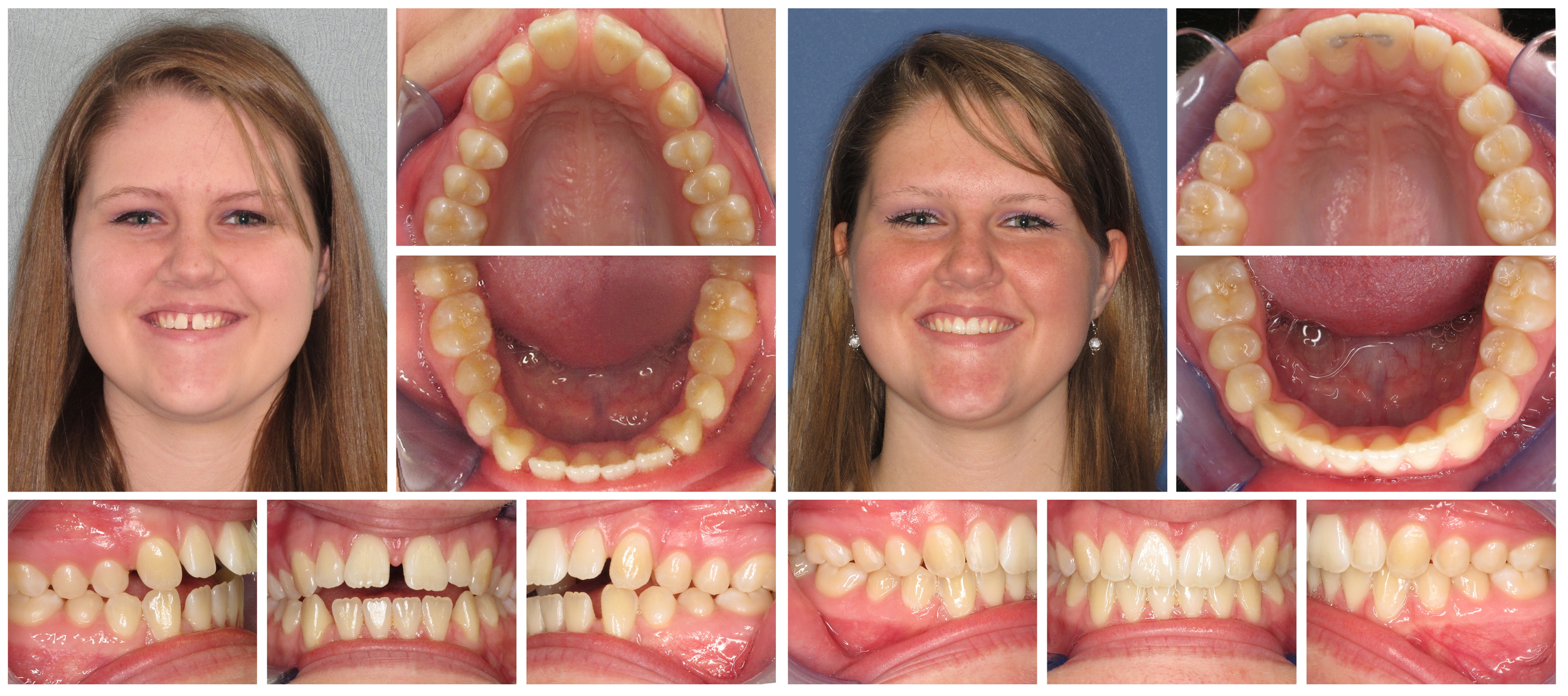 Teen girl 2 composite before & after Invisalign