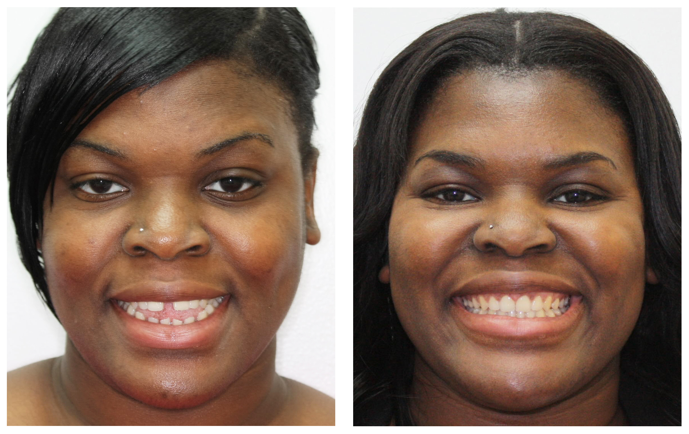Adult woman 2 extraoral before & after Invisalign
