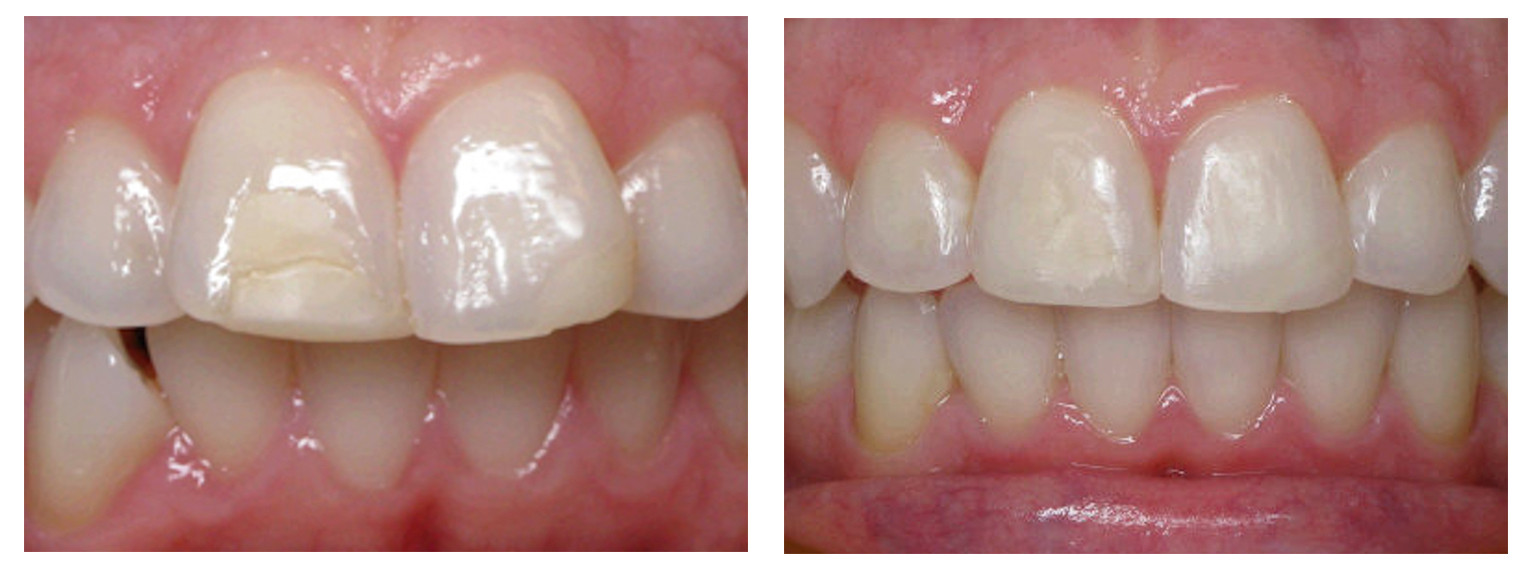 Woman anterior before & after Invisalign