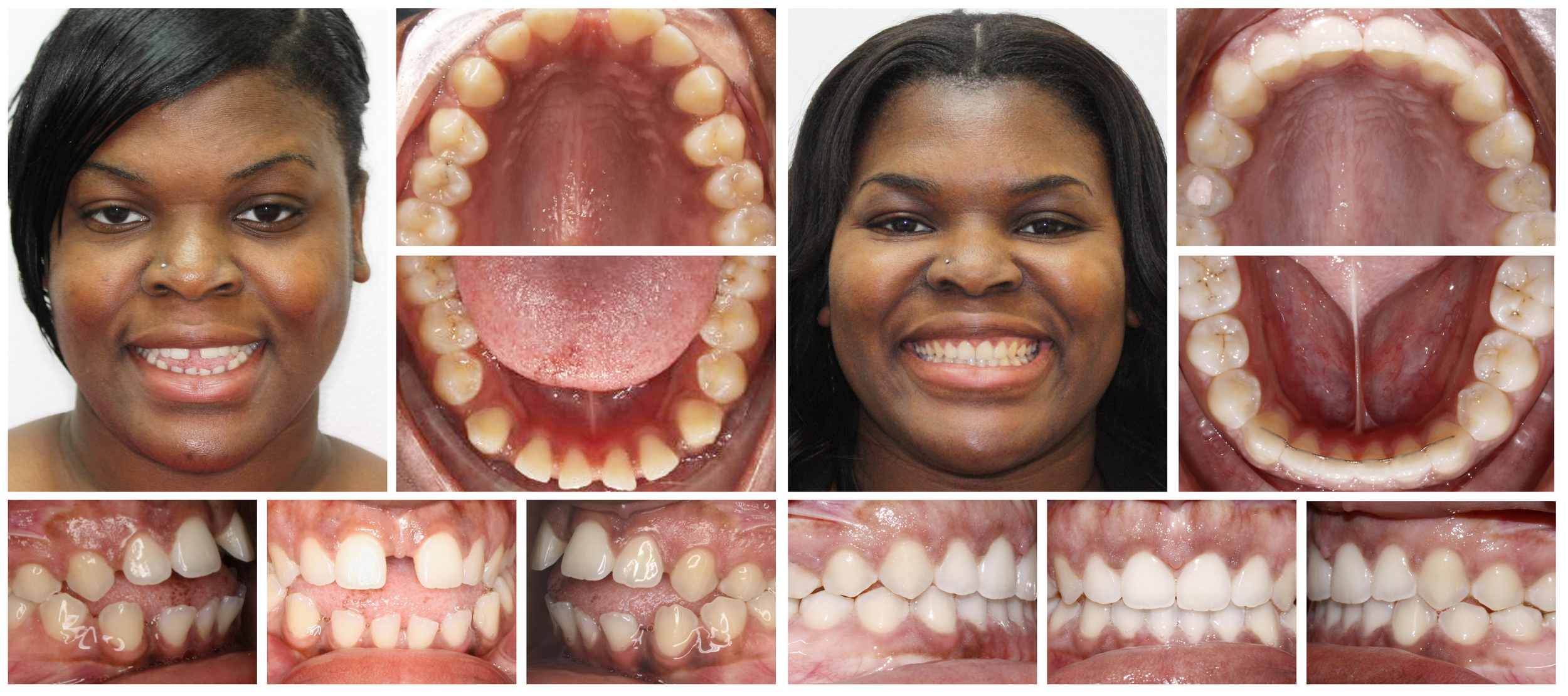 Woman 2 composite before & after Invisalign treatment