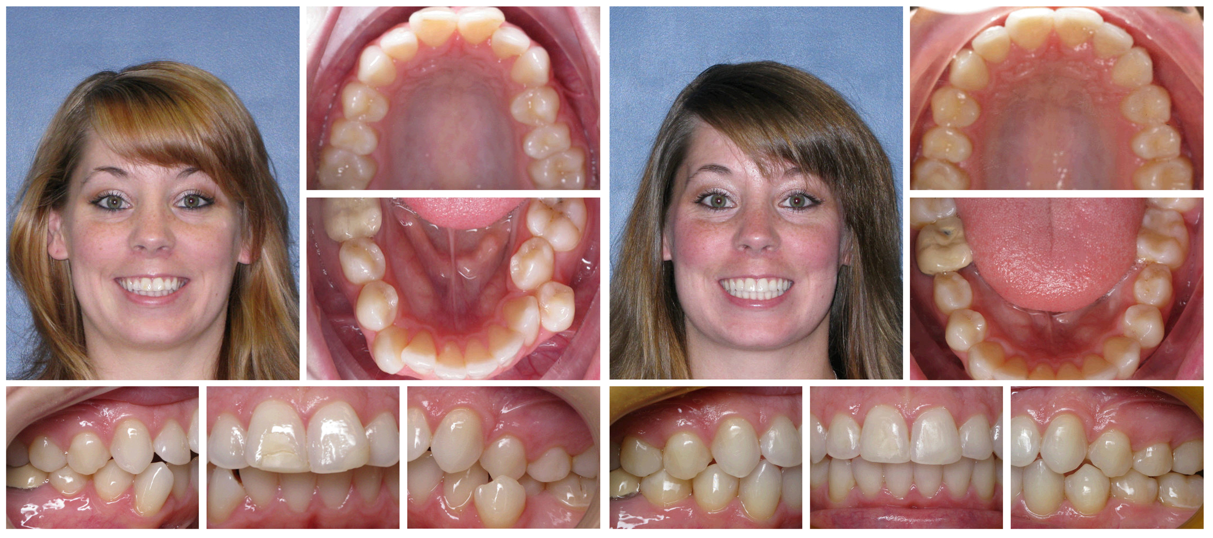 Woman composite before & after Invisalign