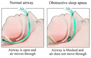 Obstructive Sleep Apnea (OSA) is caused by obstruction of the upper airway. 