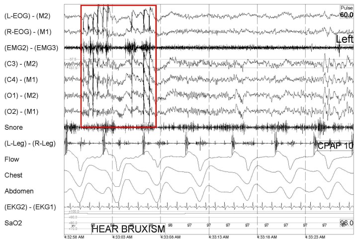 Bruxism during sleep as identified through a sleep study.