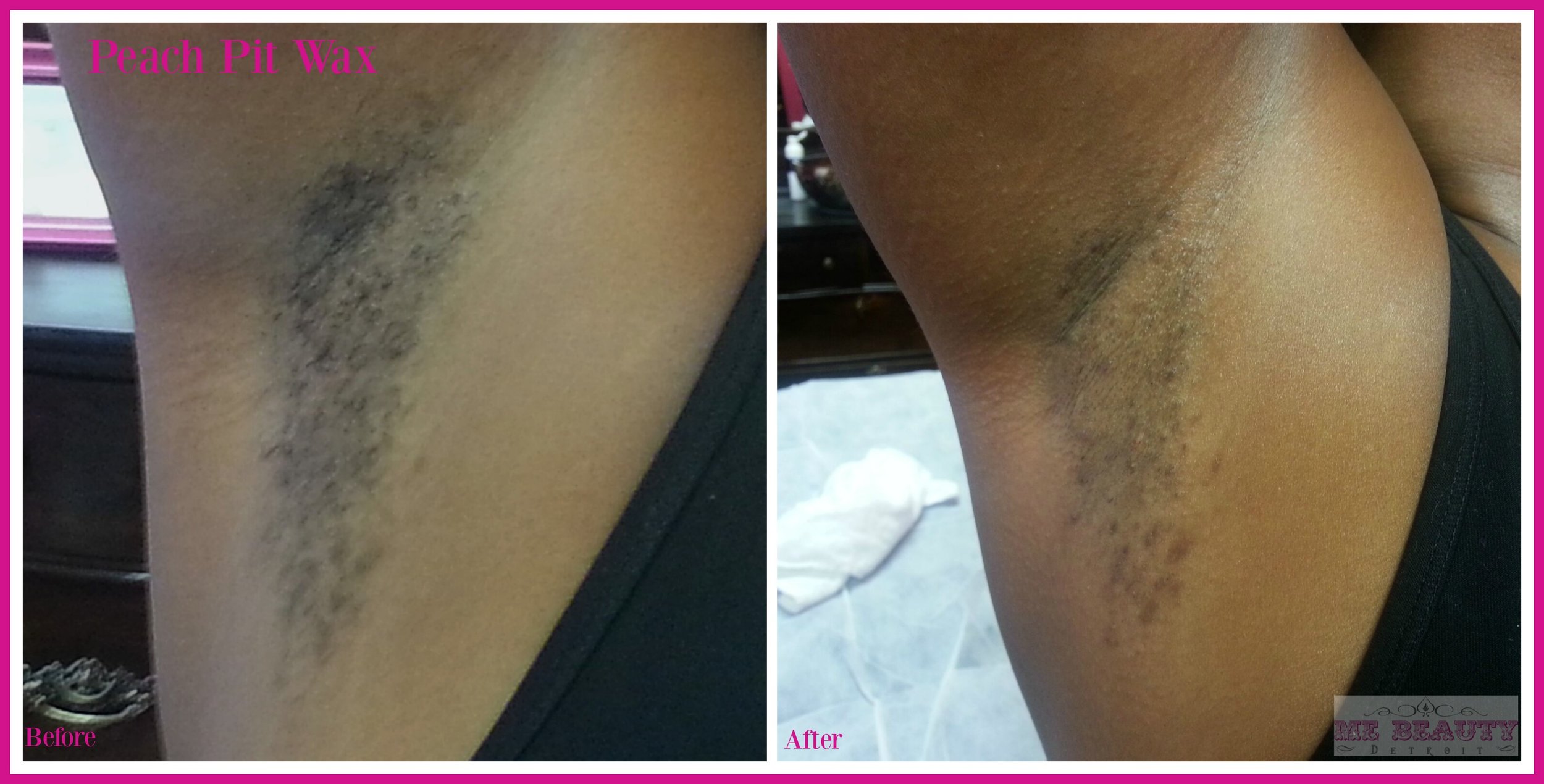 African American Female 20s has ingrown hairs, and hyper-pigmentation. &...