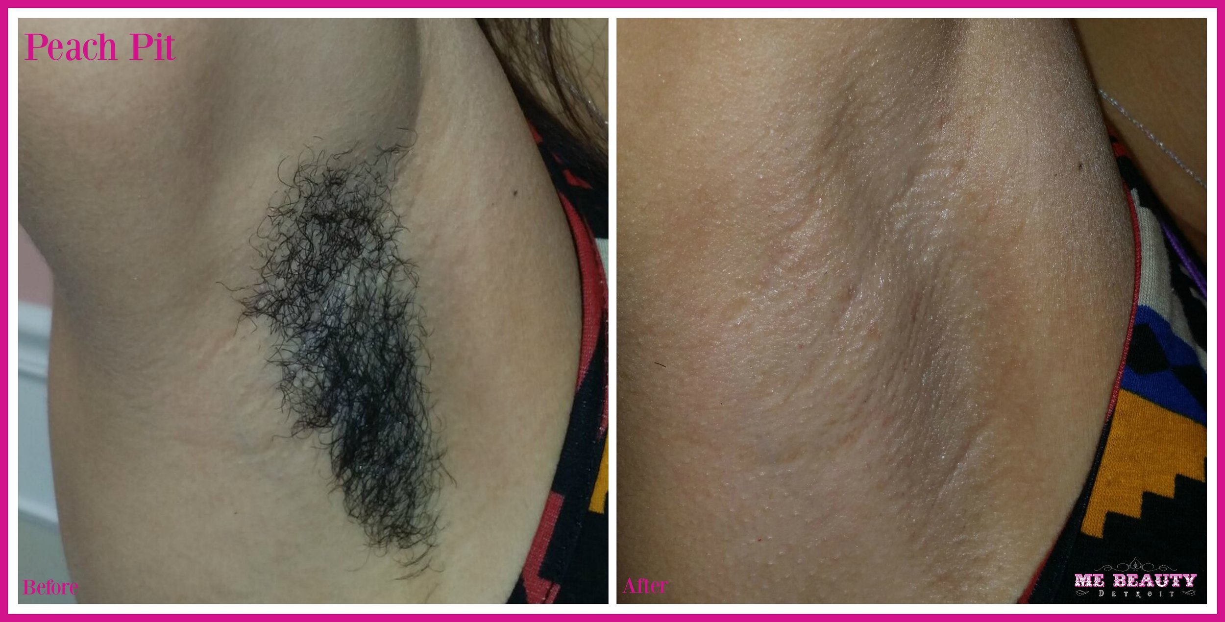 Brazilian Wax Pictures Before And After Female.