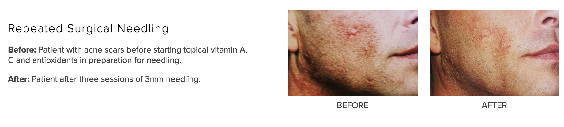VITAMIN A:NEEDLING SCARRING.png