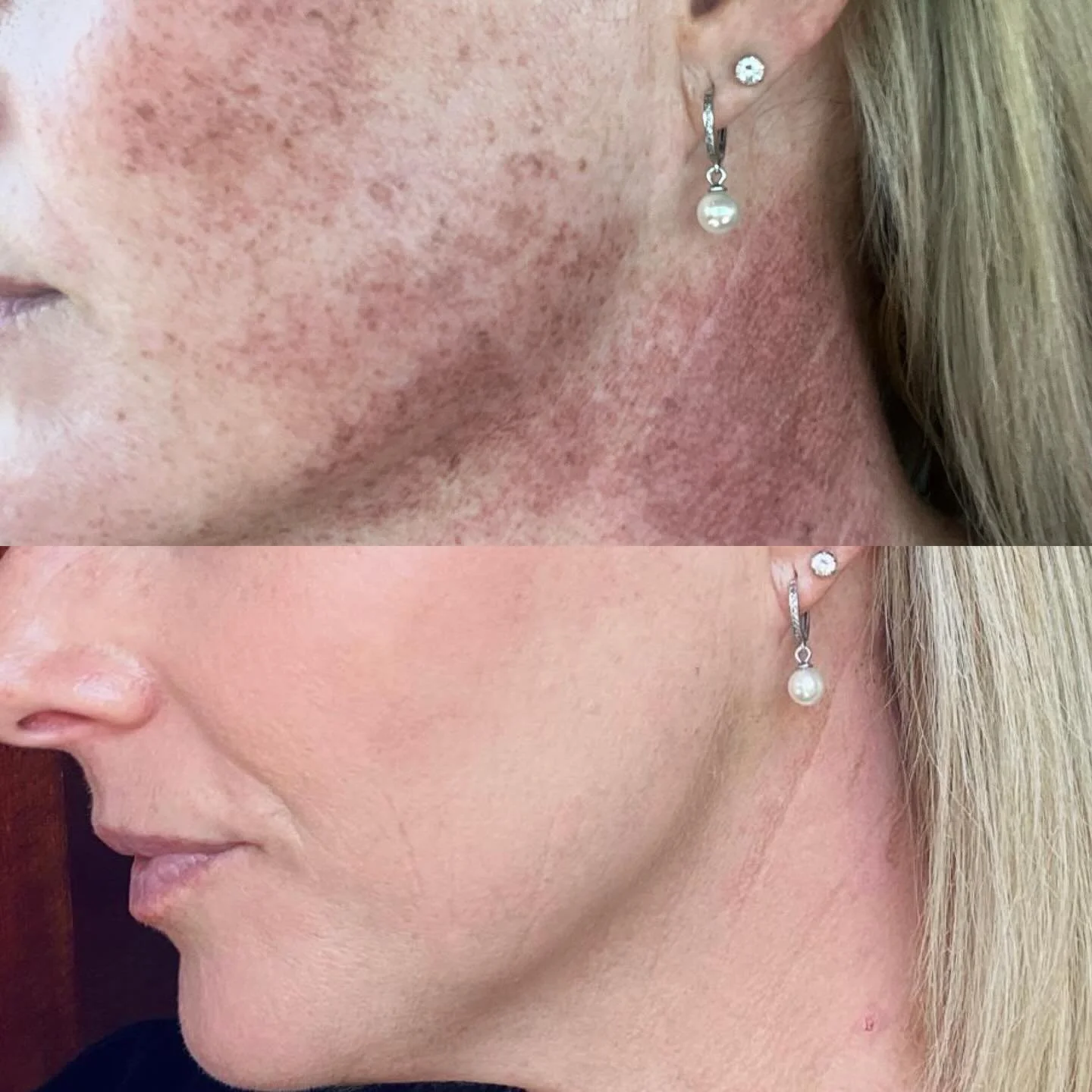 Winter is the Season for Pigmentation Correction

These beautiful before &amp; after results were achieved with IPL (Intense Pulsed Light)&mdash;one of the most effective treatments for reducing unwanted pigmentation, sun damage, freckles, and uneven