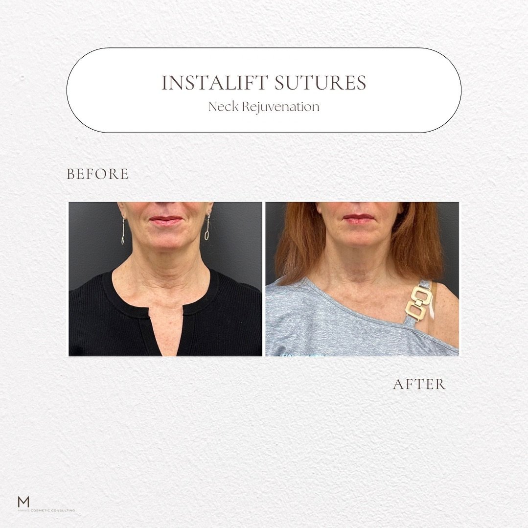 Transform your neckline! 🌟 Swipe to see stunning before-and-after results of our neck rejuvenation treatments. Discover the power of personalized care and advanced techniques at Manis Cosmetic Consulting. Book your consultation today and reveal a sm