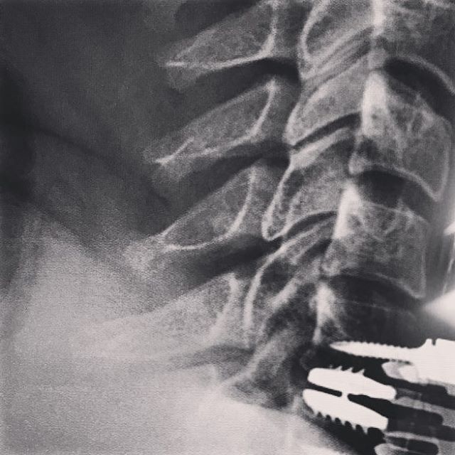 Got a fancy new disc put in my neck last week. I am starting to feel human again. ππ» Nothing like being forced to slow down and rest to make me realize how many angels I have in my life. I am so humbled and thankful for all the help and prayers from so many this past week. π