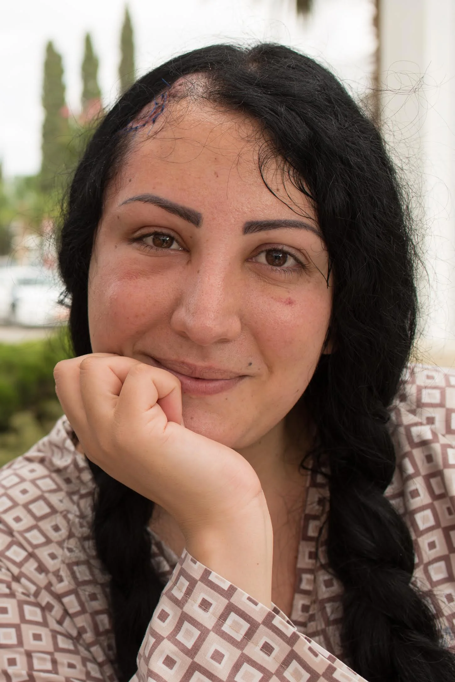 buthaina scar 2.jpg