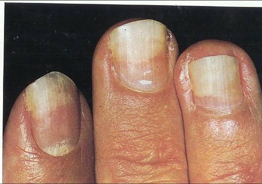 Effects Of Nutrient Deficiency On The Nails: What Do They Indicate About  Your Health?