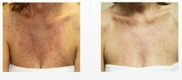 chest-skin-treatment-woodland-hills.png