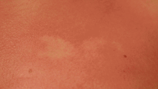 sunburn.gif