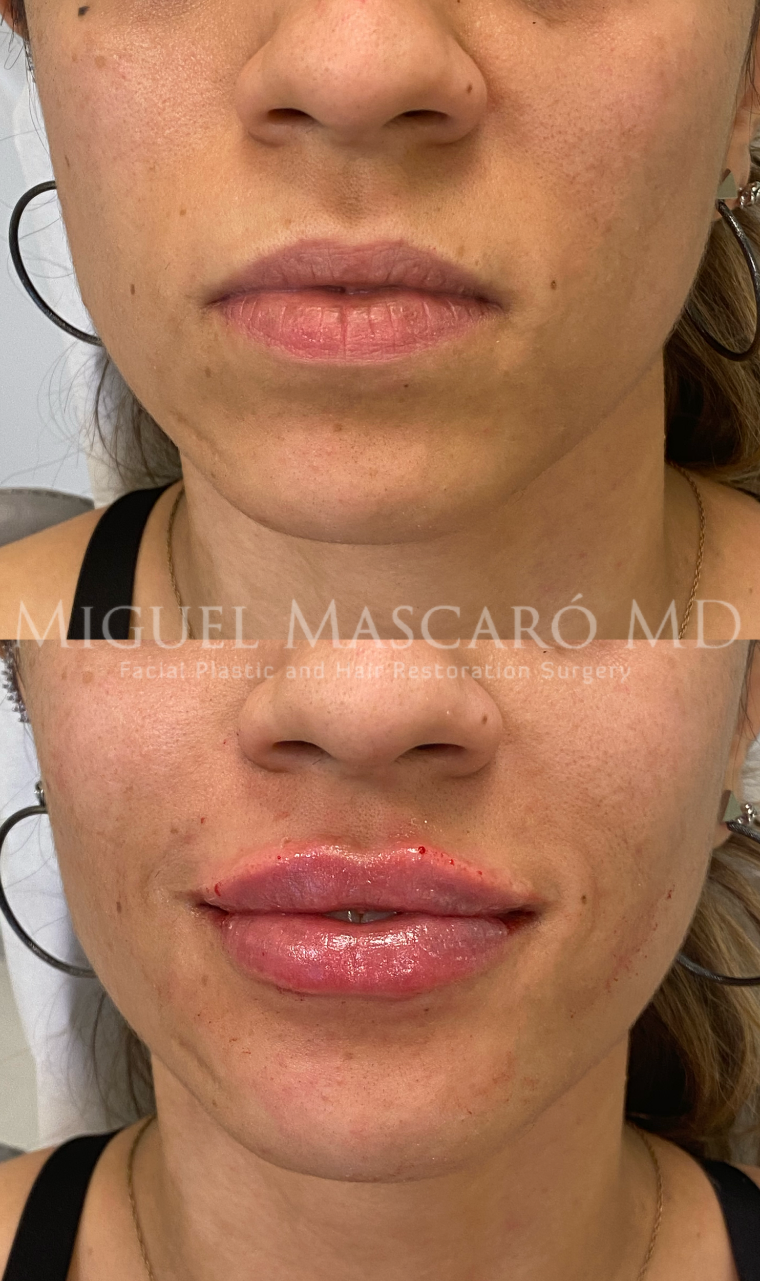  Lip filler for natural definition and pout  