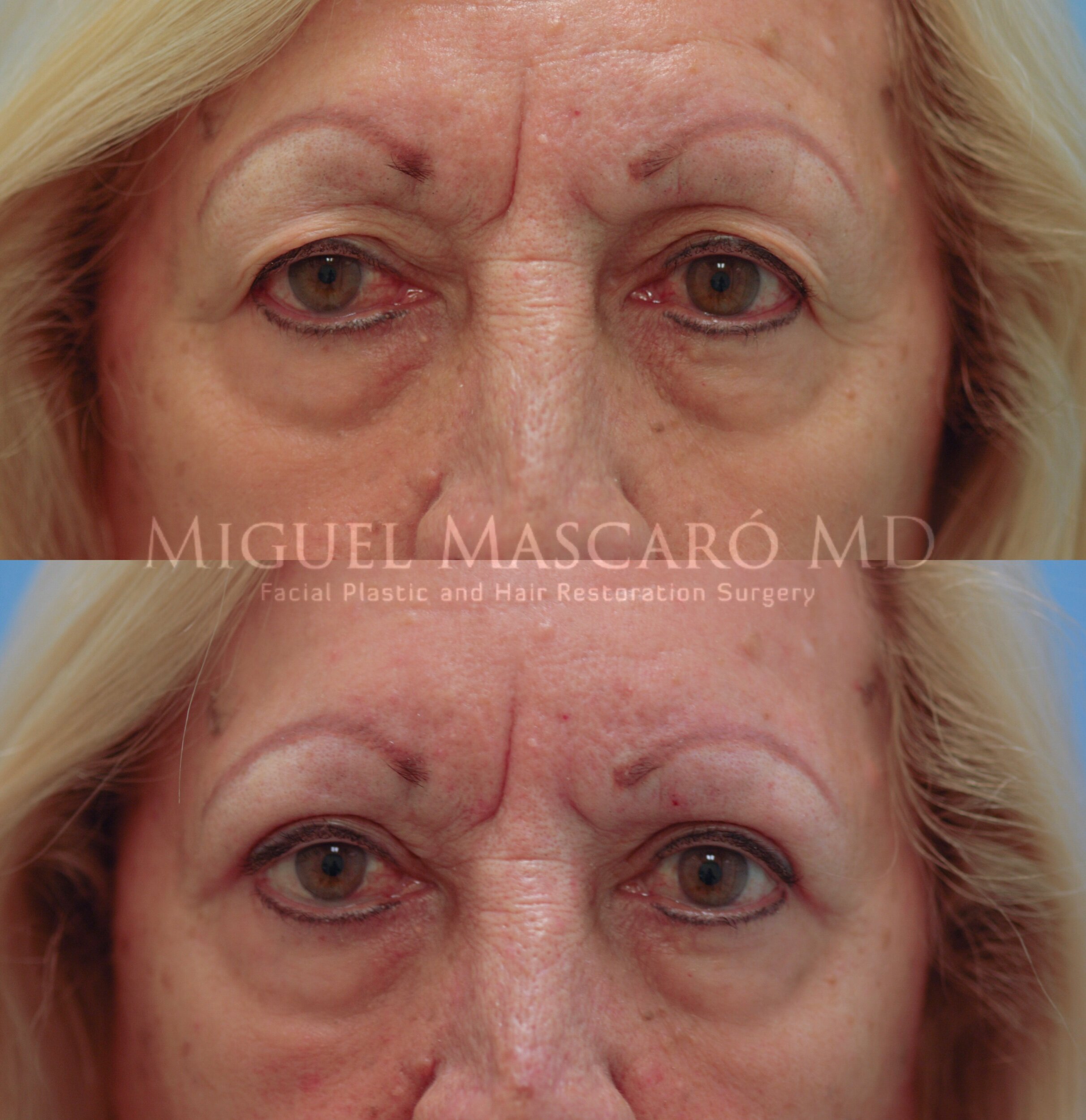  upper blepharoplasty  