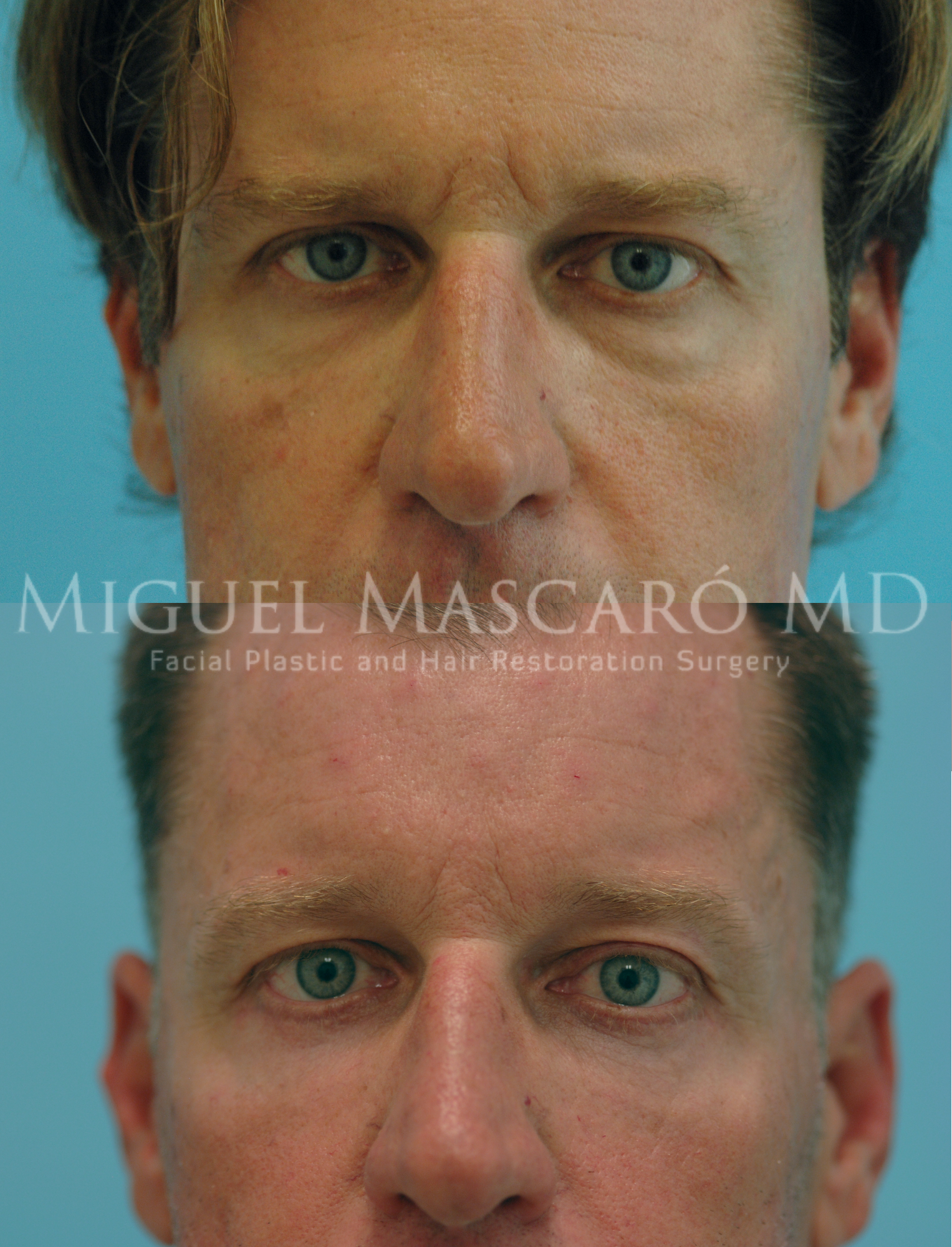  Lower blepharoplasty    