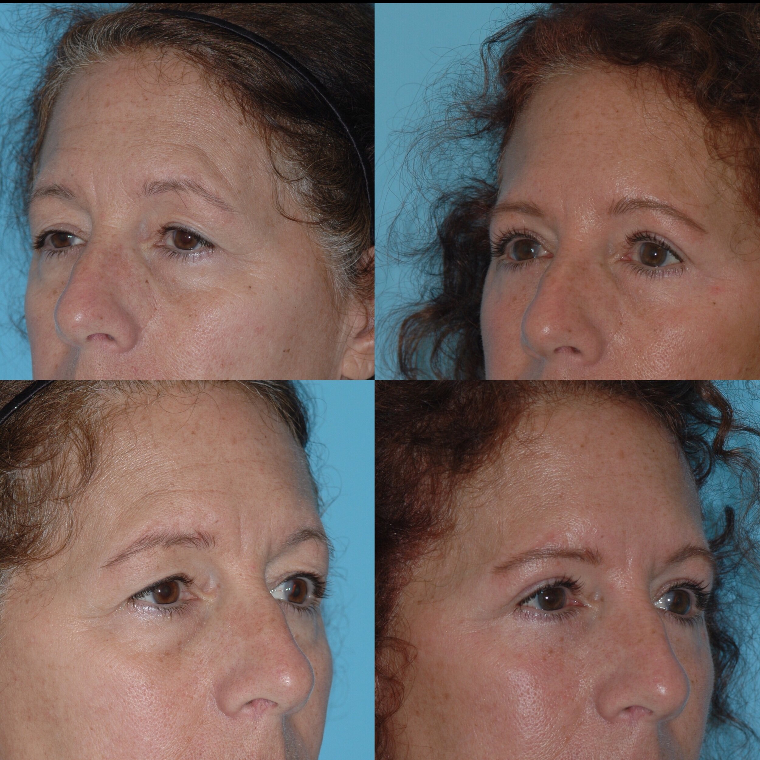  upper blepharoplasty  