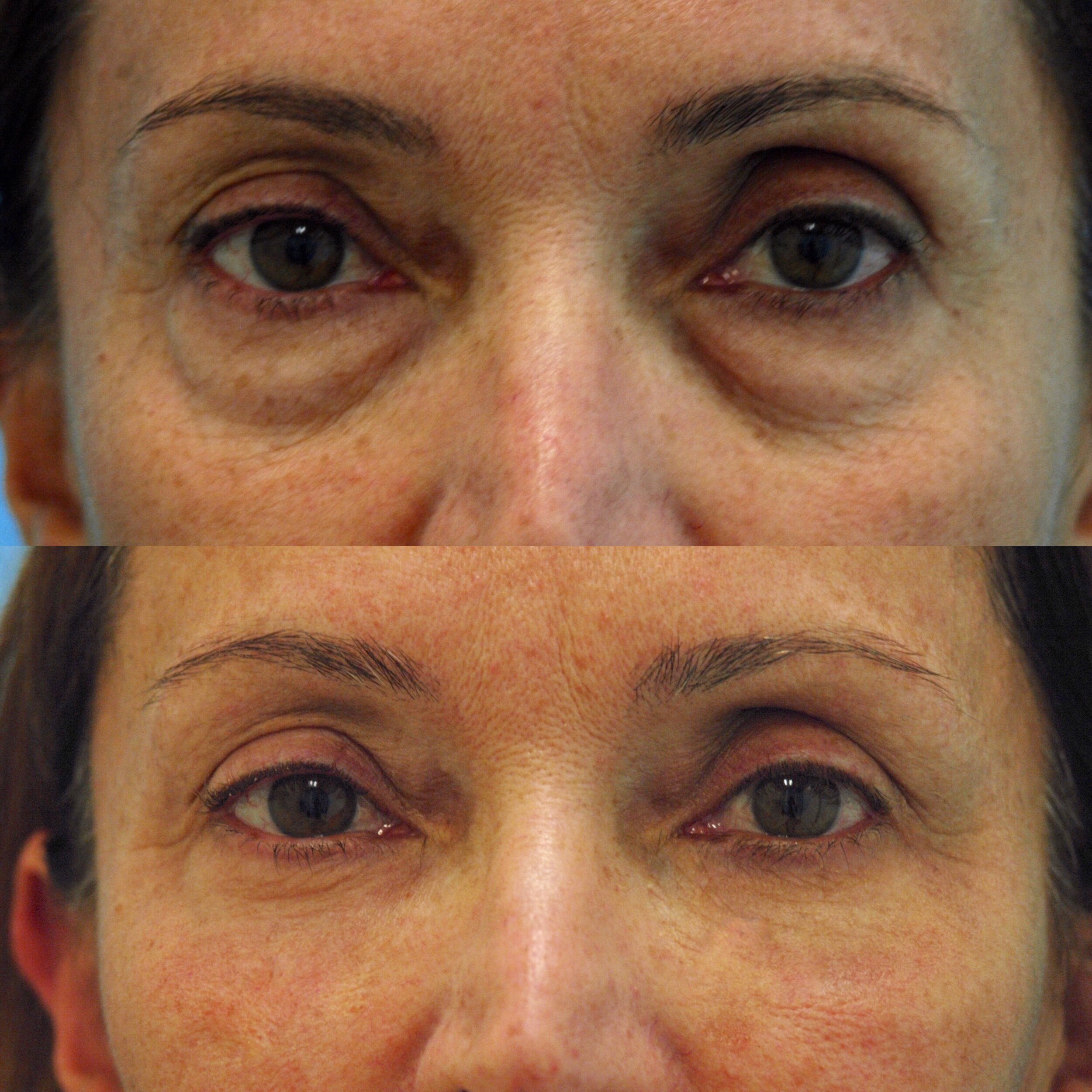  Lower blepharoplasty with fat transfer  
