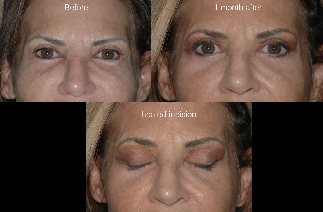  upper blepharoplasty  