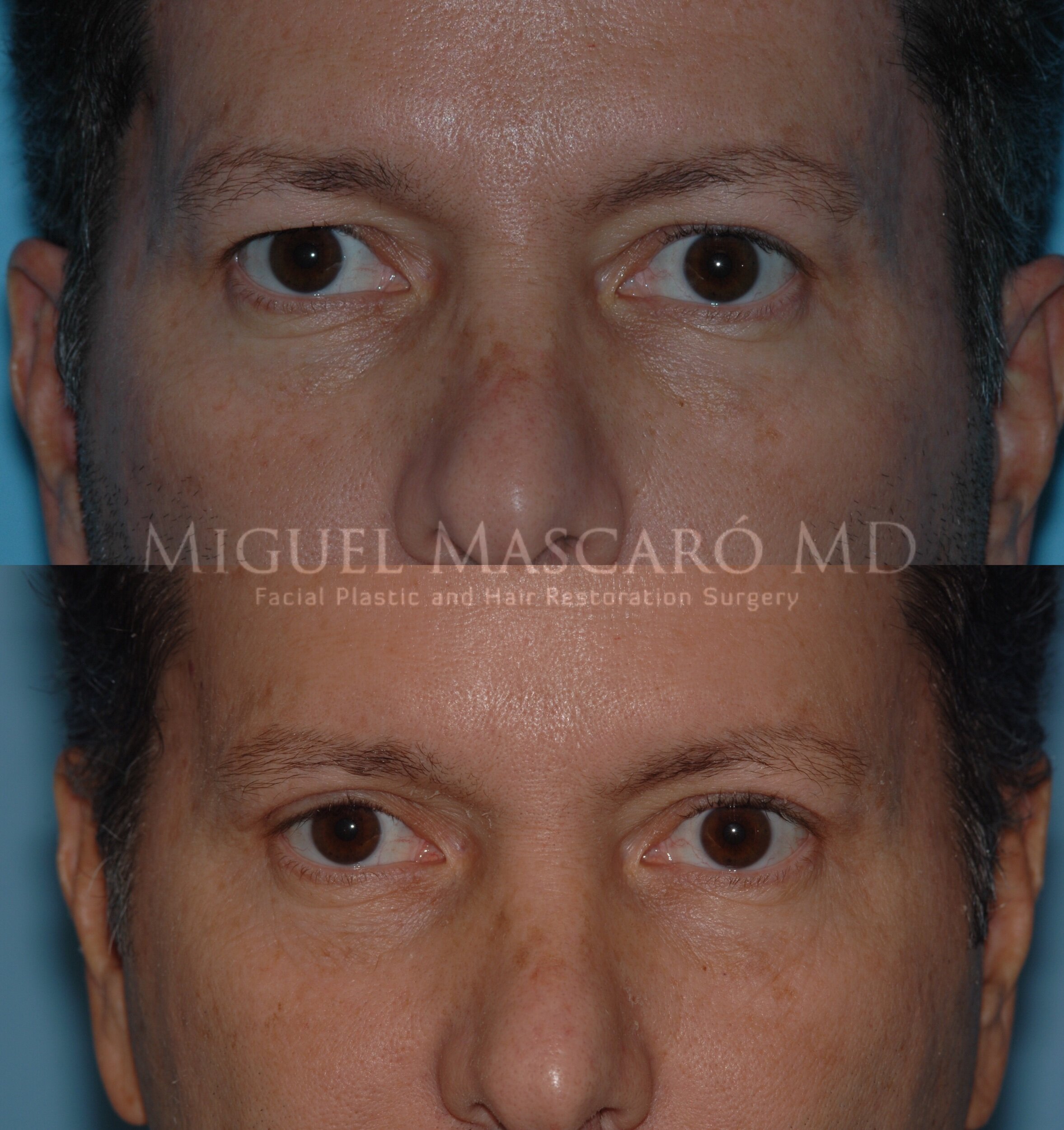  upper blepharoplasty  