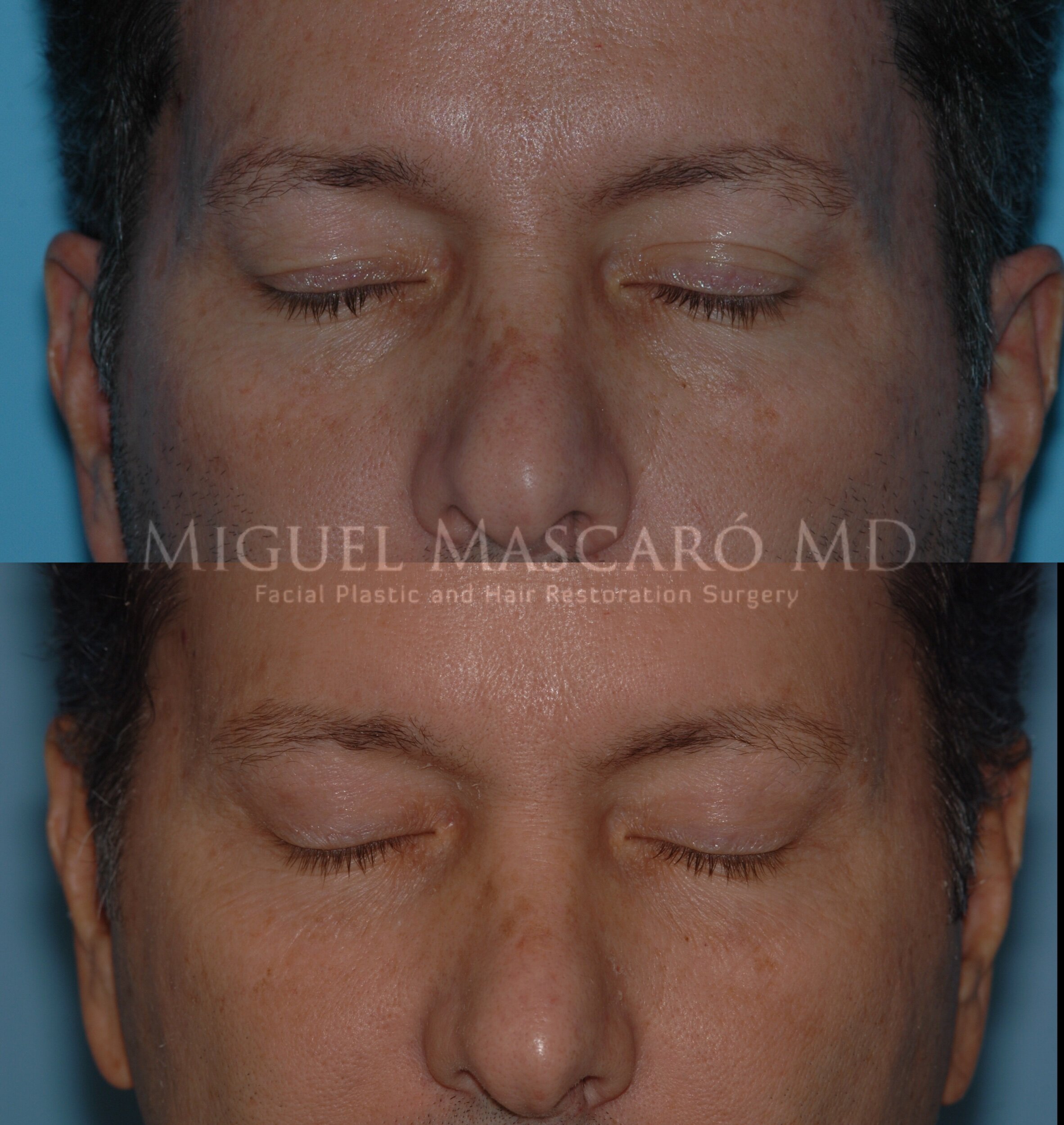  upper blepharoplasty   