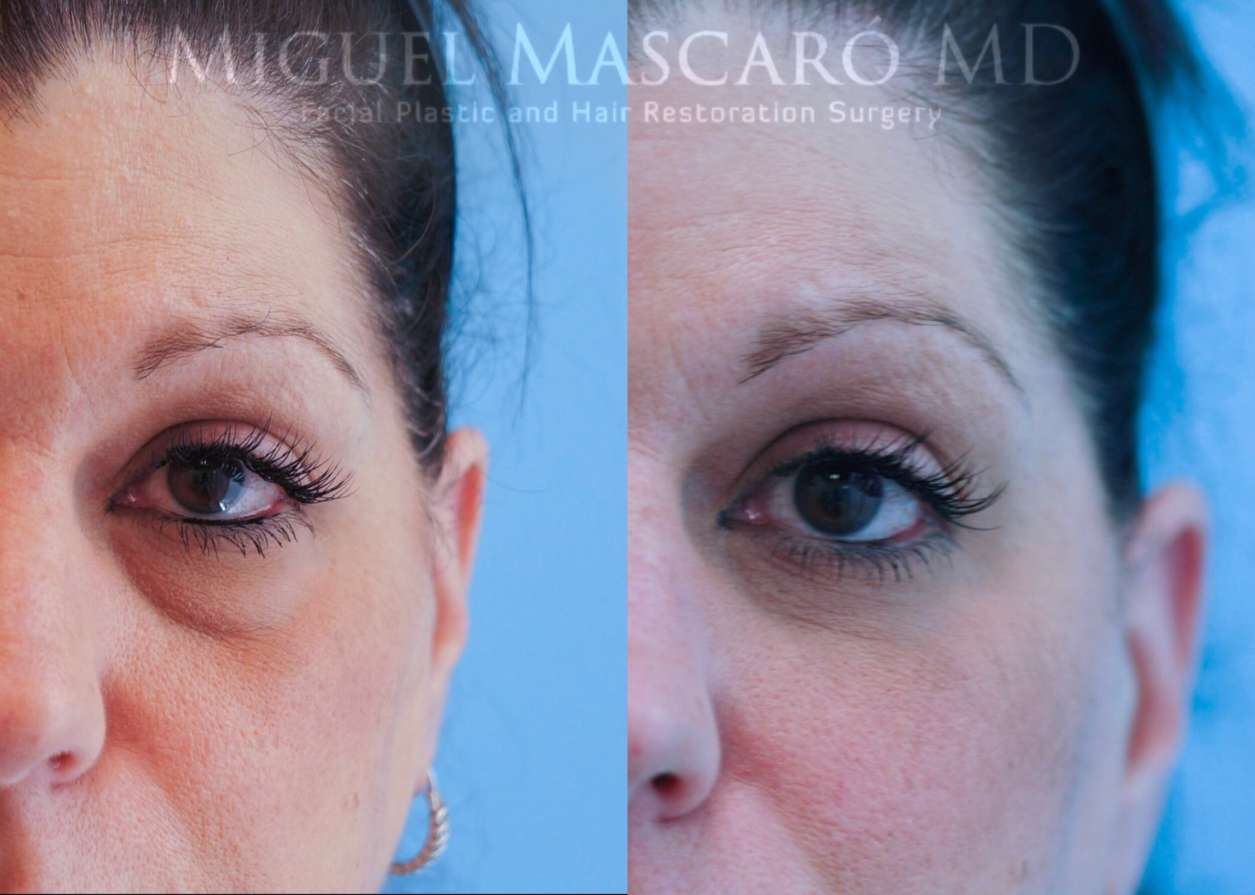 Lower blepharoplasty with fat transfer   