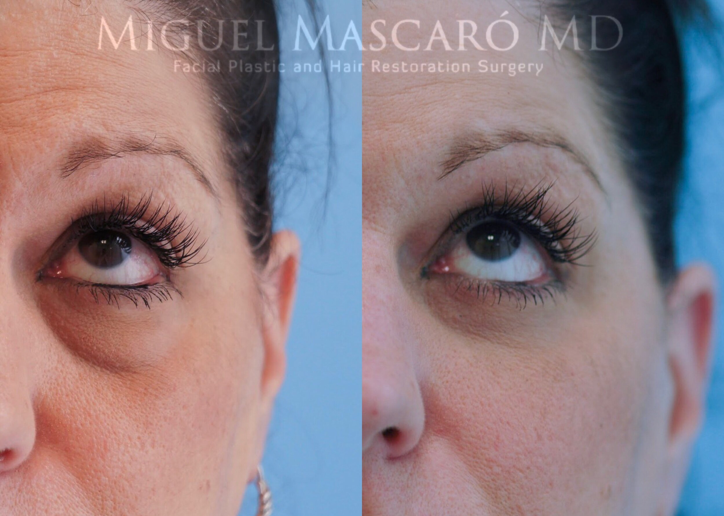  Lower blepharoplasty with fat transfer   