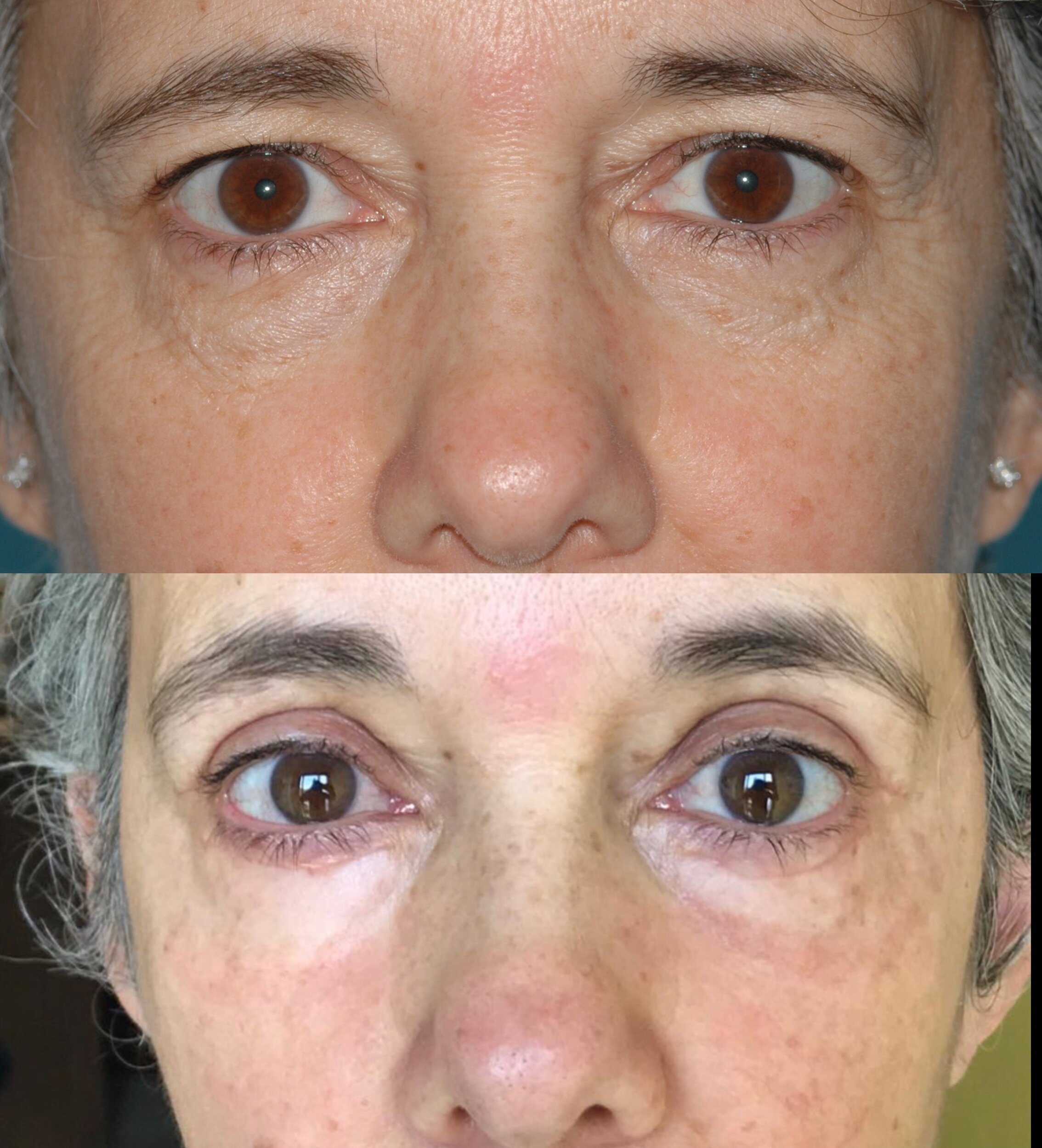  upper blepharoplasty and lower eyelid CO2   