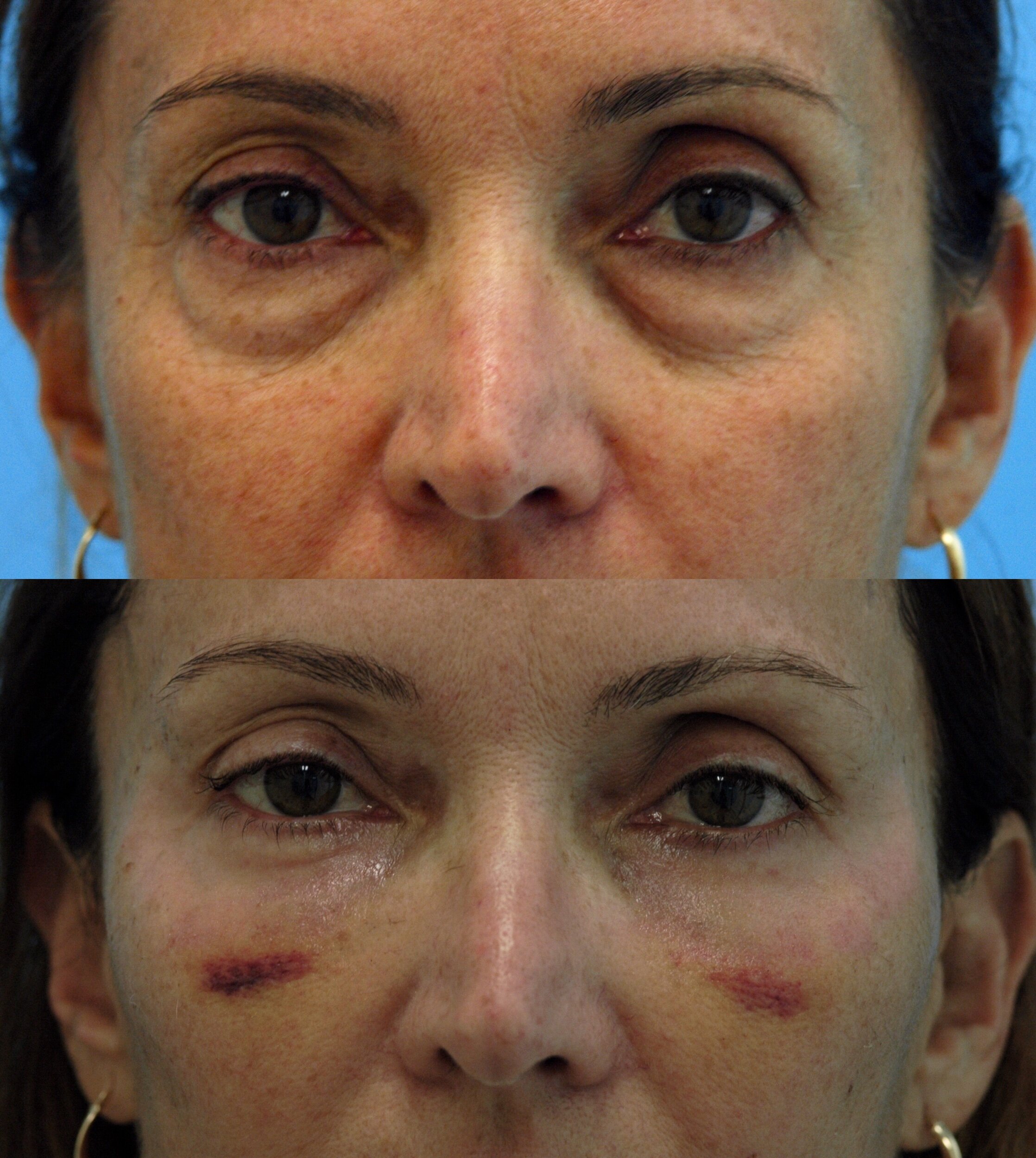  Lower blepharoplasty with fat transfer - 1 week out    