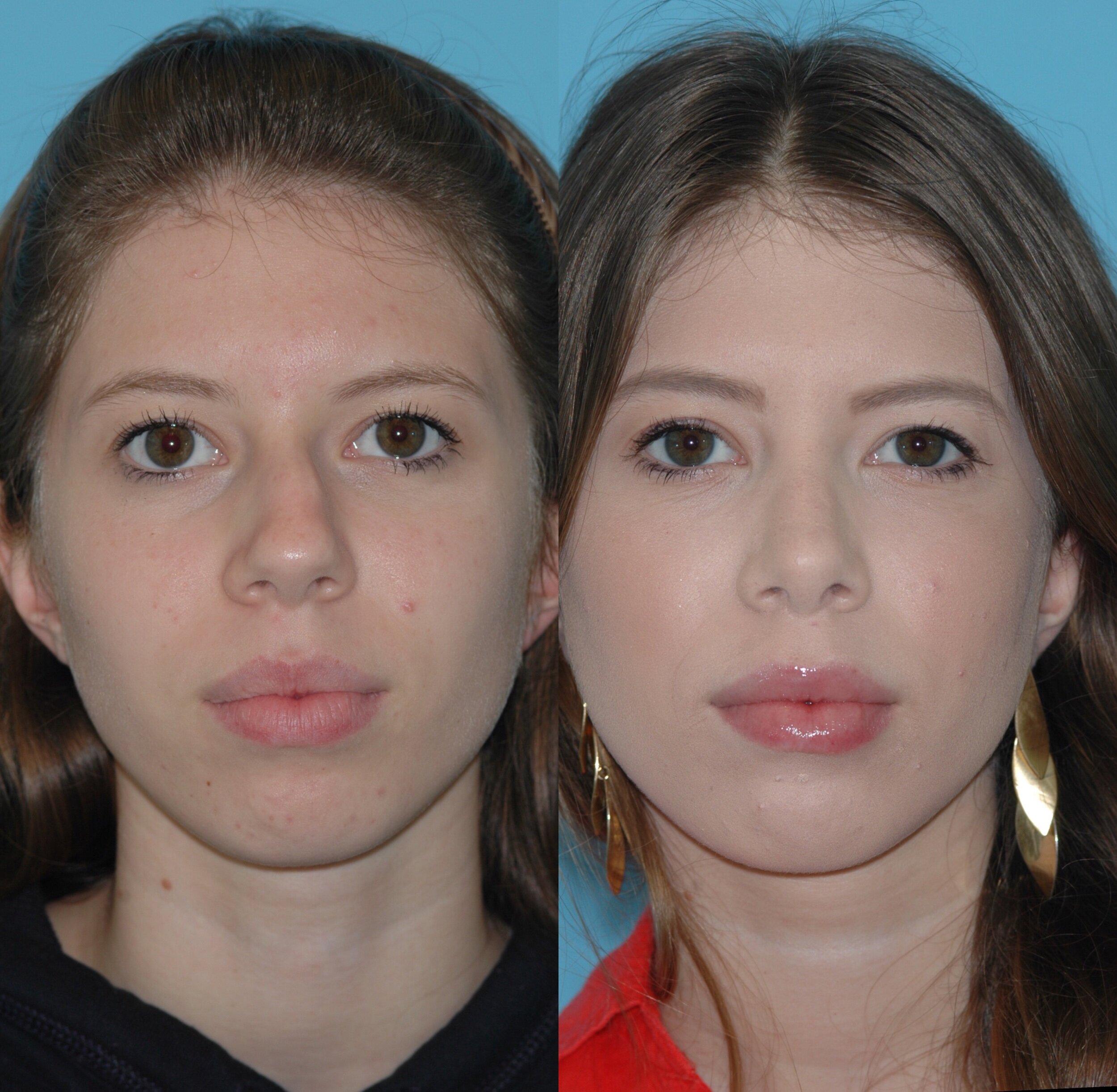  closed rhinoplasty  