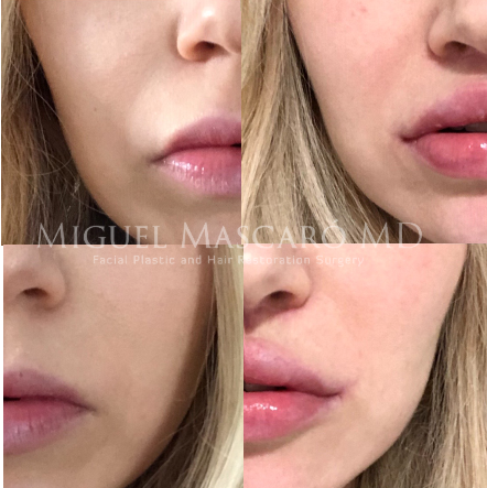  4 months post lip lift, right medialized corner lift, left wrap around corner lift  