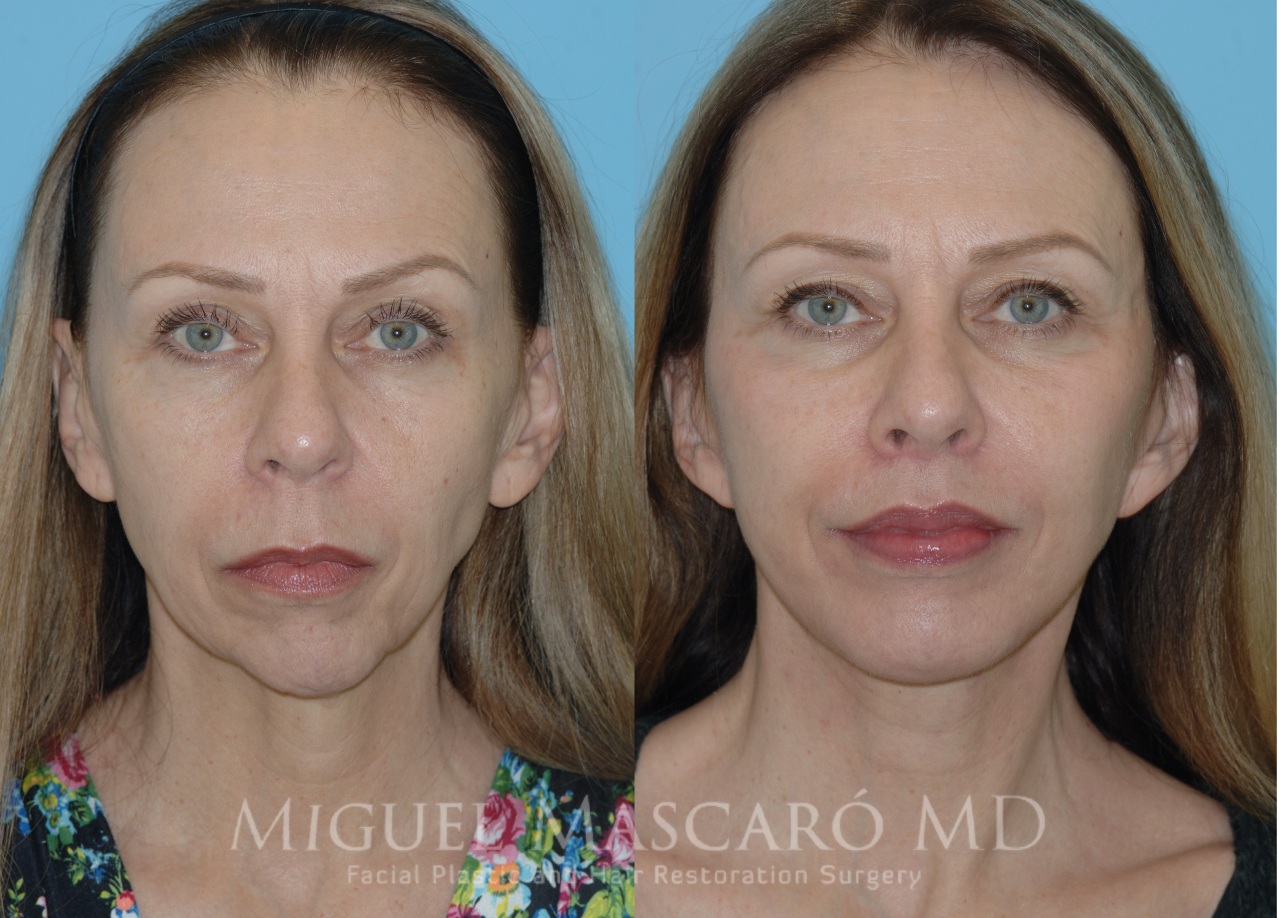  deep plane facelift, chin implant, lip lift, midface fat grafting  