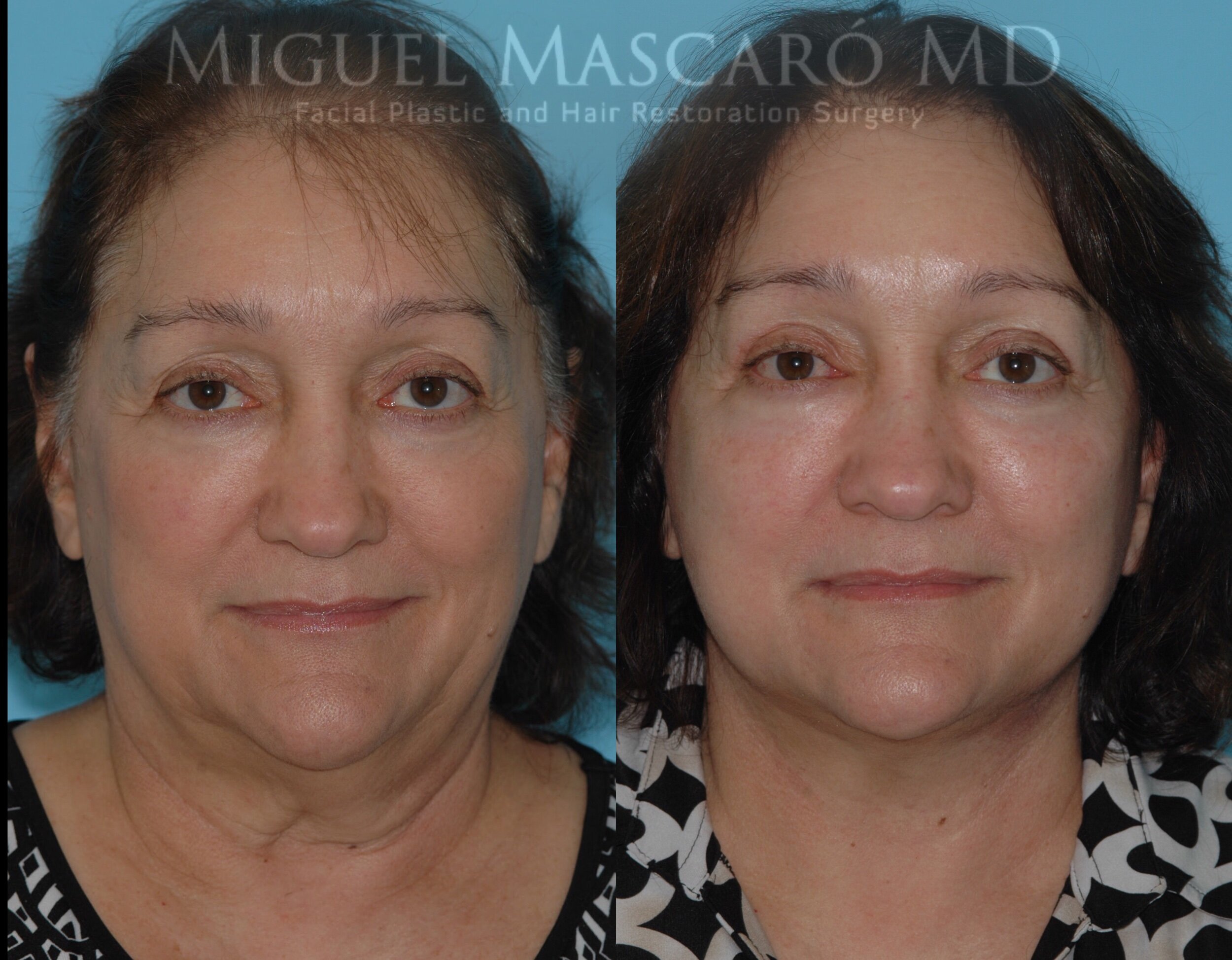  Deep plane facelift and liposuction  