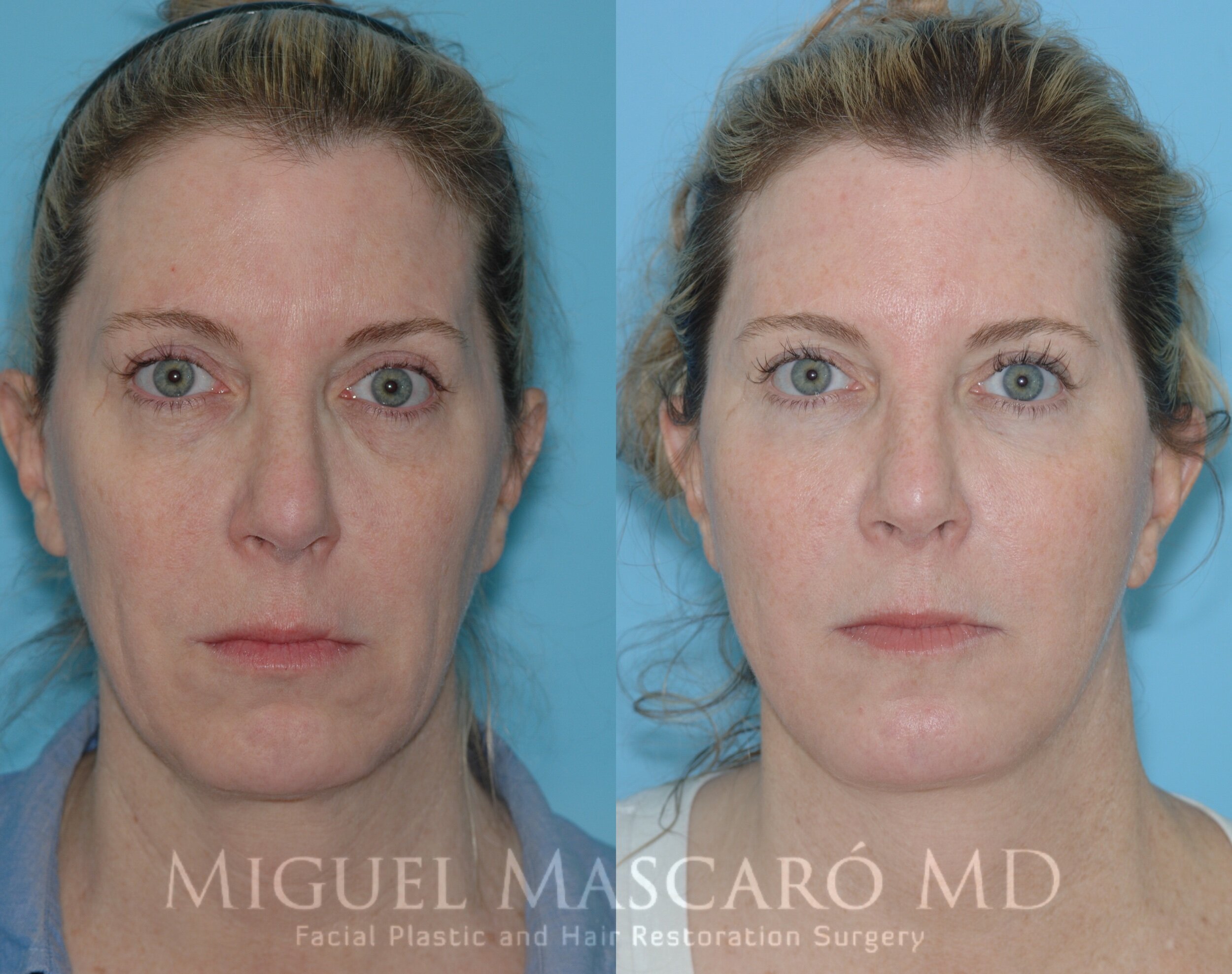  Deep plane facelift, mid face fat grafting, full face CO2 laser  