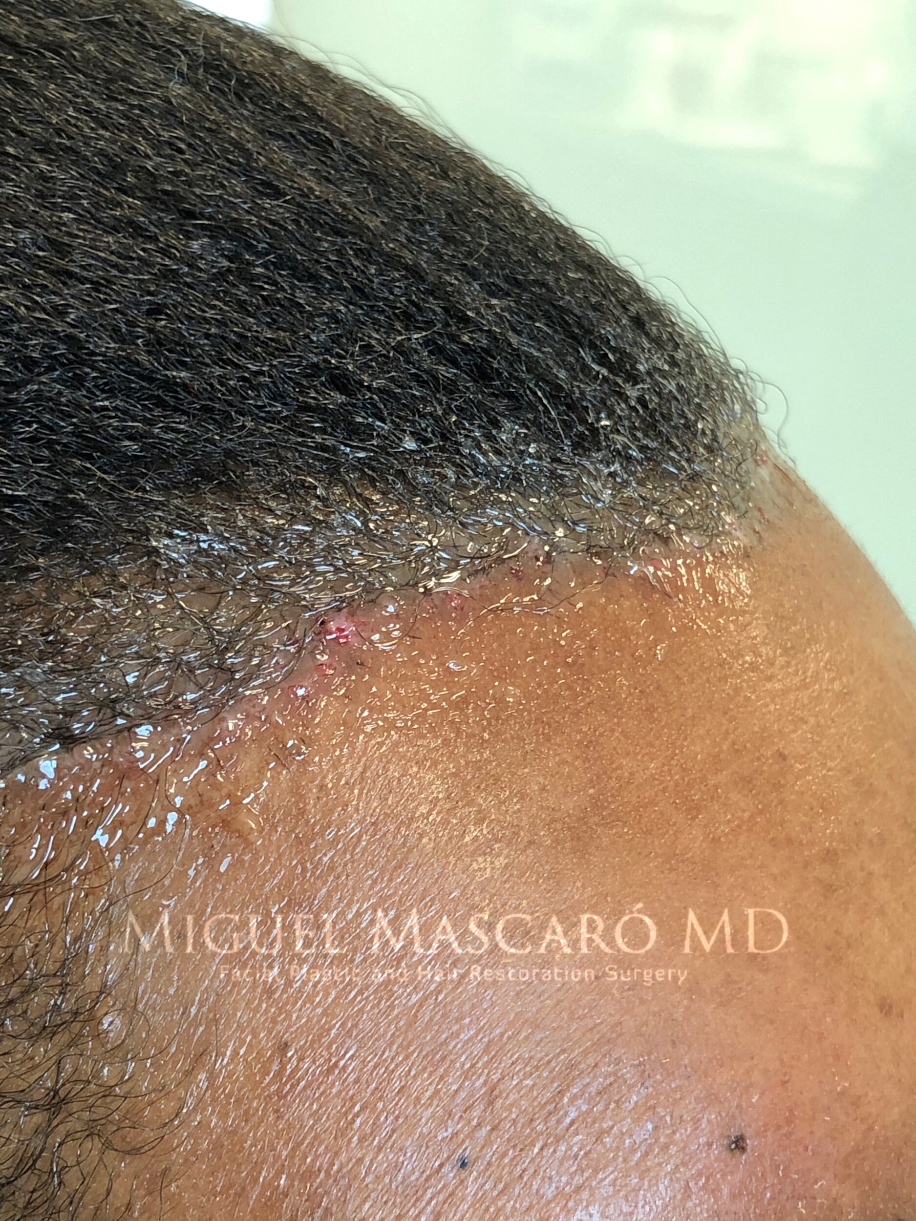  hairline incision at 7 days  